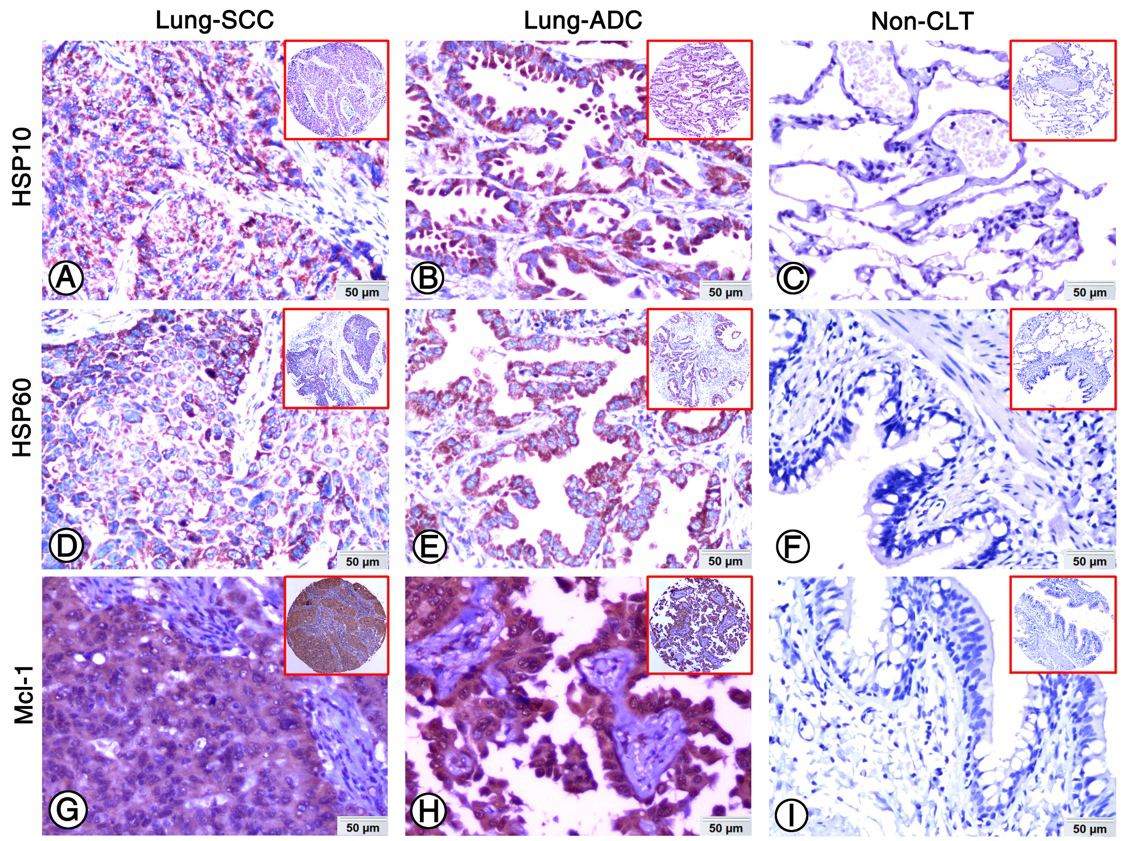 Expression of HSP10, HSP60 and Mcl-1 in lung ADC, lung SCC and Non-CLT were detected by IHC. Strong positive staining of HSP10 (A), HSP60 (D) and Mcl-1 (G) was found in cell cytoplasm of lung SCC cells. Strong positive staining of HSP10 (B), HSP60 (E) and Mcl-1 (H) was also showed in cell cytoplasm of lung ADC cells. Negative staining of HSP10 (C), HSP60 (F) and Mcl-1 proteins was found in Non-CLT (200 ×, IHC, DAB staining).