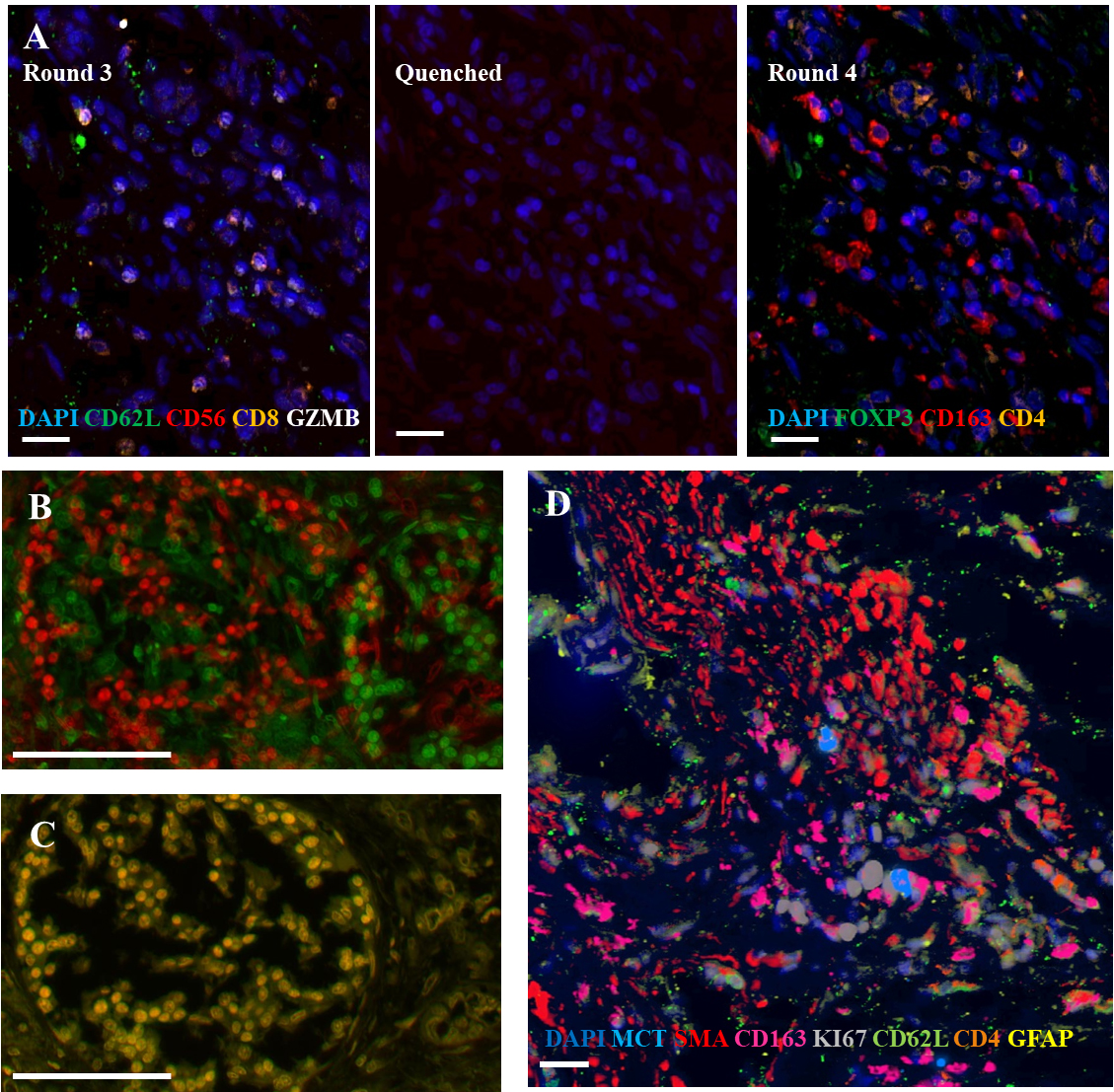 Representative images from cyclic multiplexed-immunofluorescence (MxIF) labeling of a primary PDAC tumor with image registration. A) Images showing distinct marker distributions in the same area across staining round 3, quenching and re-scanning at the same intensity, and re-staining round 4. Scale bar = 20 μm. B) Unaligned image of DAPI staining of the same area from round 1 (green) and 9 (red) . C) Alignment (overlaid yellow) of round 1 and 9 DAPI using image registration software. Scale bar = 100 μm. D) Aligned composite image showing a subset of markers from different rounds of the MxIF panel. Scale bar = 20 μm.