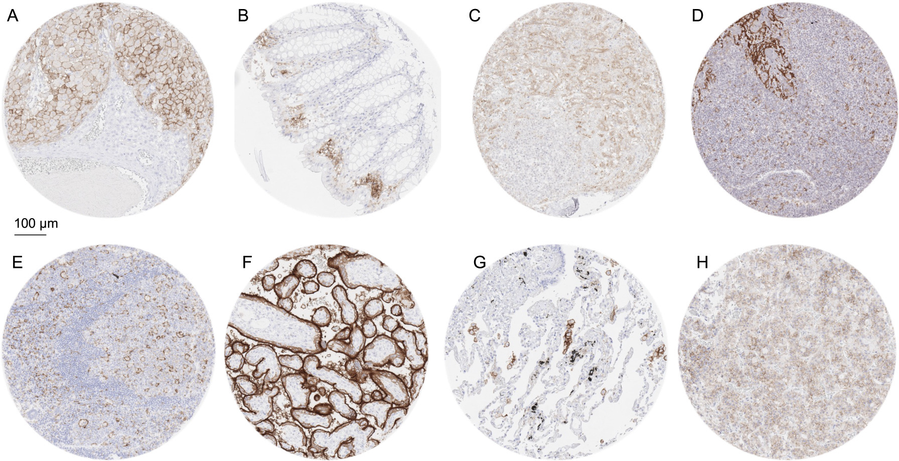 PD-L1 immunostaining of normal cells using MSVA-711R. The panels show a membranous PD-L1 positivity of Corpus luteum cells in the ovary (A), macrophages in colon epithelium (B), small (littoral) blood vessels in the spleen (C), a fraction of crypt epithelial cells and macrophages of the tonsil (D), dendritic cells and macrophages in a lymph node (E), surface membranes of the syncytiotrophoblast in the placenta (F), alveolar macrophages in the lung (G) and of a fraction of epithelial cells in the adenohypophysis.