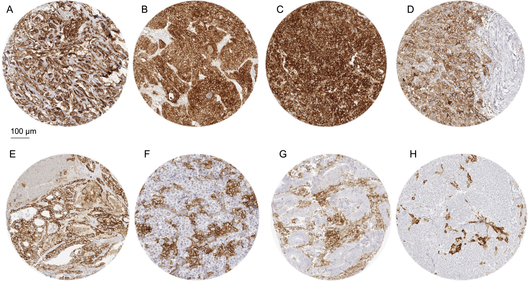 PD-L1 immunostaining in cancer using MSVA-711R. The panels show a strong, predominantly membranous PD-L1 immunostaining of tumor cells in an epitheloid malignant mesothelioma (A), a muscle-invasive urothelial carcinoma (B), a squamous cell carcinoma of the oral cavity (C), and an anaplastic thyroid cancer (D). A papillary carcinoma of the thyroid shows a membranous staining of both cancer cells (strong intensity) and macrophages (moderate intensity) (E). Cases of seminoma (F), colorectal adenocarcinoma (G), and a Merkel cell carcinoma of the skin (H) do not show tumor cell staining but contain macrophages with intense PD-L1 positivity.