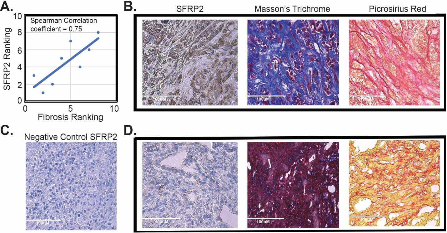 SFRP2 expression is associated with fibrosis in vivo. (A) Correlation of SFRP2 staining and degree of fibrosis in tumors from KPC mice (n= 8). (B) Representative images of staining from a KPC mouse that had high SFRP2 staining and high levels of fibrosis identified by Masson’s trichome blue staining and picrosirius red staining. (C) Negative control for SFRP2 immunohistochemistry staining. (D) Representative images of staining from a KPC mouse that had low SFRP2 staining and low levels of fibrosis identified by Masson’s trichome purple staining and picrosirius yellow staining. All slides at 40X HPF: High Power Field. Scale bar: 100 μm.