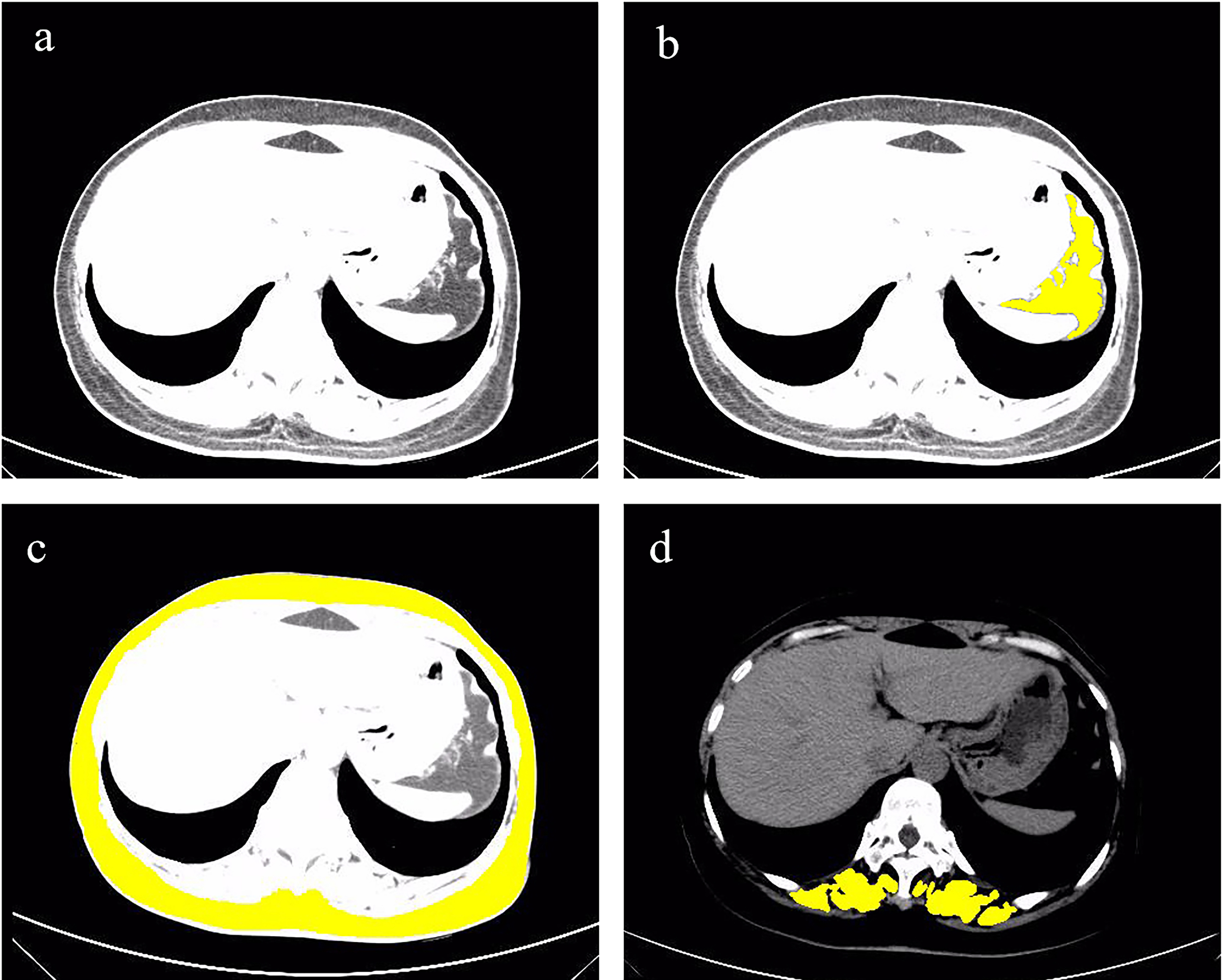 CT image of T11 level, paraspinal muscles, subcutaneous fat and visceral fat. Figure (a) is the CT image of the T11 level. The yellow area in Figure (b) is the visceral fat in the T11 level CT image. The yellow area in (c) is the subcutaneous fat in the T11 level CT image. The yellow area in (d) is the paraspinal muscles in the T11 level CT image.