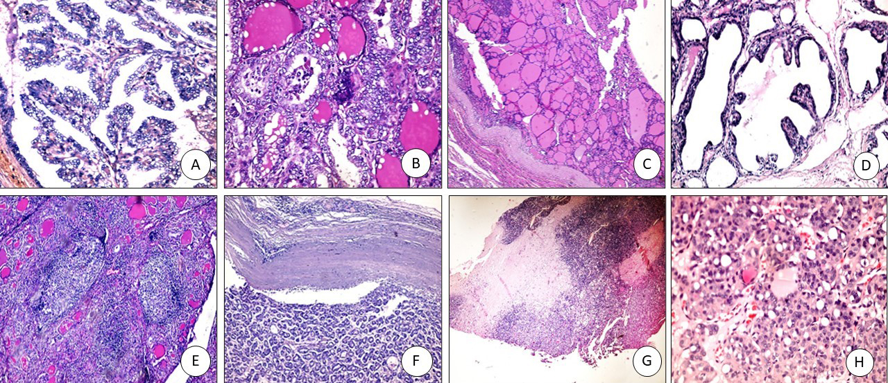 (A) PTC: papillary projections with nuclear features of PTC (X 200), (B) FVPTC: capsulated tumor with prominent nuclear features of PTC (X200), (C) Colloid goiter: variable sized follicles with flat lining (X100), (D) Graves’ disease: hyperplastic thyroid follicles with papillary projections (X200), (E) Hashimoto thyroiditis: prominent lymphoid follicles with abundant hurthle cells (X100), (F) follicular adenoma with intact capsule (X100), (G) Follicular carcinoma; thickened capsule with full thickness penetration (X100), (H) Follicular carcinoma with prominent atypia and mitosis (X200).