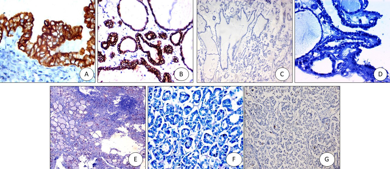 TROP2 immunostaining: (A) PTC positive membranous staining (x400), (B) FVPTC: positive membranous staining (x200), (C) Colloid goiter: negative (x200), (D) Graves’ disease with papillary hyperplasia-negative (x400), (E) Hashimoto negative (x100), (F) Follicular adenoma negative (x200), (G) Follicular carcinoma negative (x200).