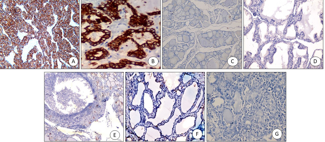 SLP2 immunostaining: (A) PTC positive cytoplasmic staining (x200), (B) FVPTC: positive cytoplasmic staining (x200), (C) Colloid goiter: negative (x200), (D) Graves’ disease with papillary hyperplasia-negative (x200), (E) Hashimoto negative (x200), (F) Follicular adenoma negative (x200), (G) Follicular carcinoma negative (x200).