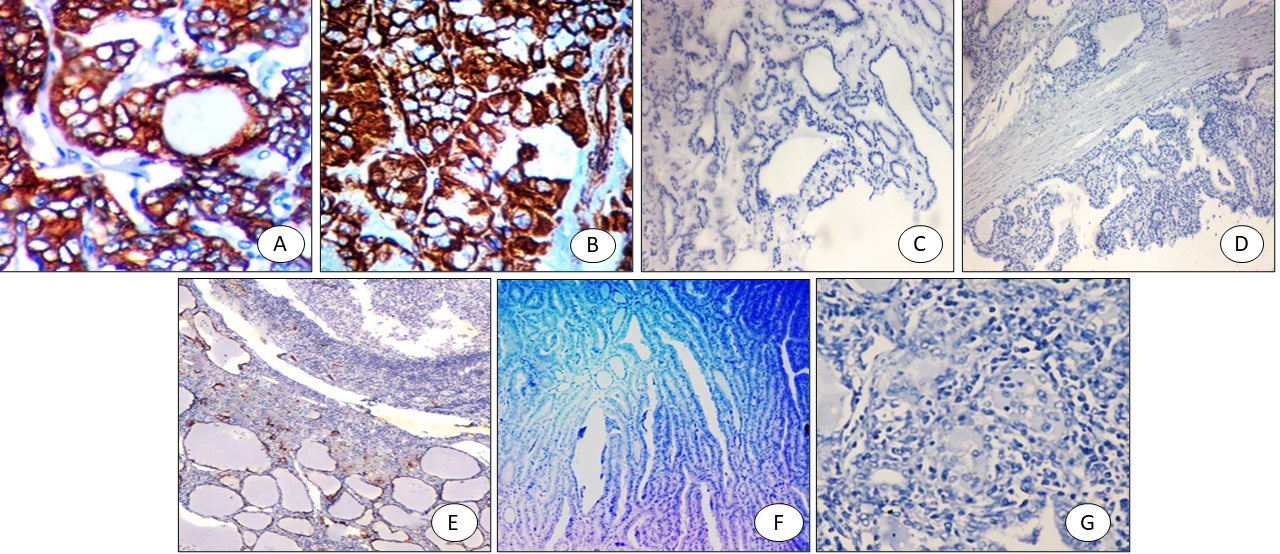 CXCL2 immunostaining: (A) PTC positive cytoplasmic staining (x400), (B) FVPTC: positive cytoplasmic staining (x200), (C) Colloid goitre: negative (x200), (D) Graves’ disease with papillary hyperplasia-negative (x200), (E) Hashimoto negative (x200), (F) Follicular adenoma negative (x200), (G) Follicular carcinoma negative (x200).