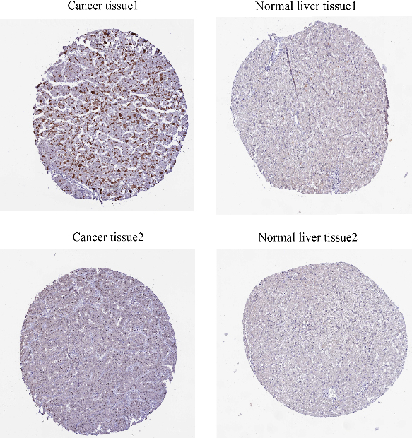Immunohistochemistry suggested that the expression of CMSS1 was higher in LIHC tissues than in normal tissues.