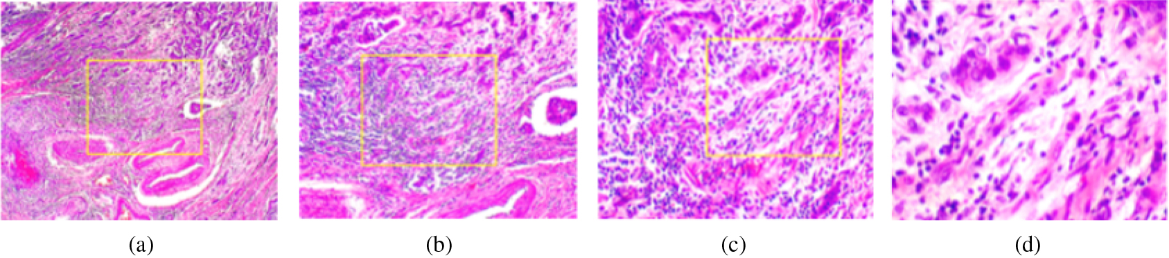 Samples of breast histopathology images acquired from BreakHis data set, illustrated in different magnification factors [76]. (a) 40X, (b) 100X, (c) 200X, and (d) 400X. 