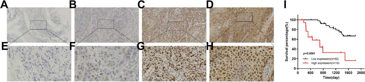 High expression of GINS2 was correlated with poor clinical outcomes. (A) Negative staining of GINS2 (magnification 100×), (B) weak staining (100×), (C) moderate staining (100×), (D) strong staining (100×), (E) negative staining (400×), (F) weak staining (400×), (G) moderate staining (400×), (H) strong staining (400×). (I) Overall survival. GINS2, GINS complex subunit 2. P< 0.0001.