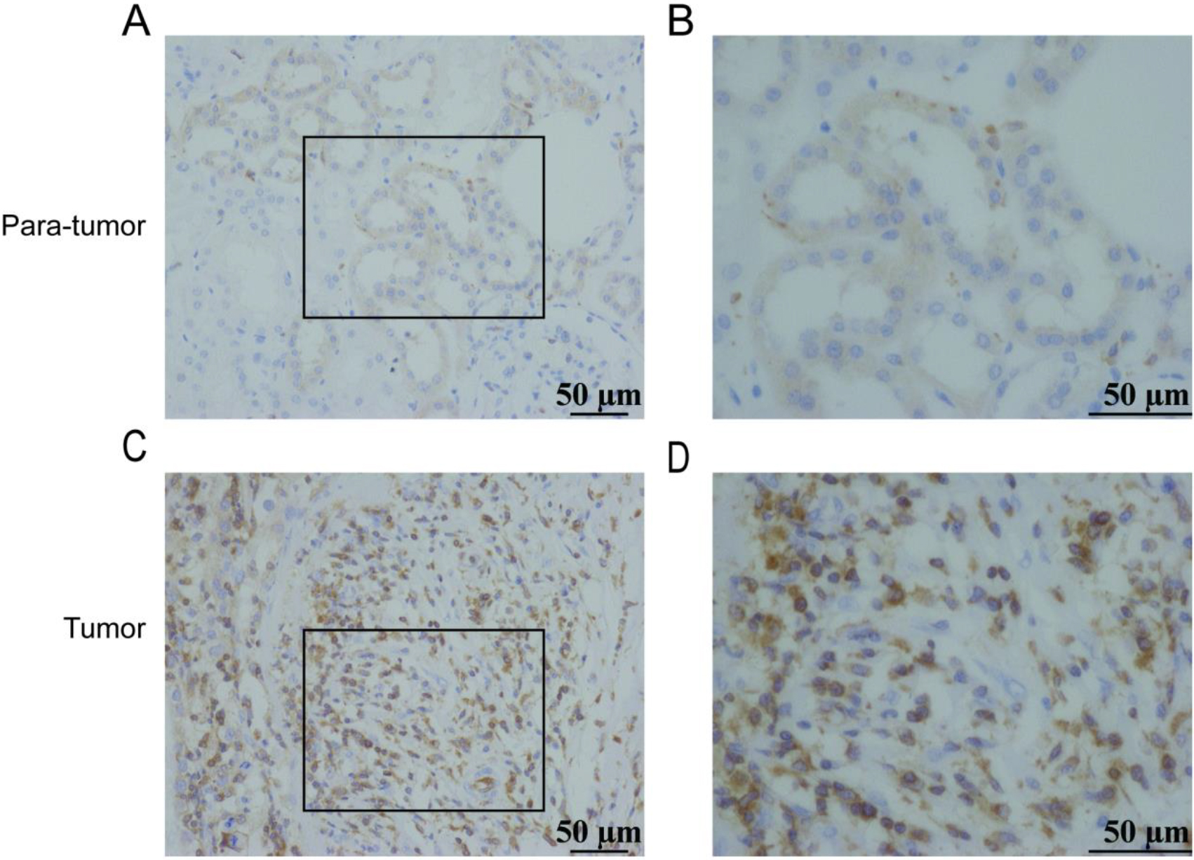 Expression of ARHGAP4 in KIRC tissues. Low expression of ARHGAP4 in para-carcinoma tissues of KIRC (A, B). High expression of ARHGAP4 in KIRC tissues (C, D).