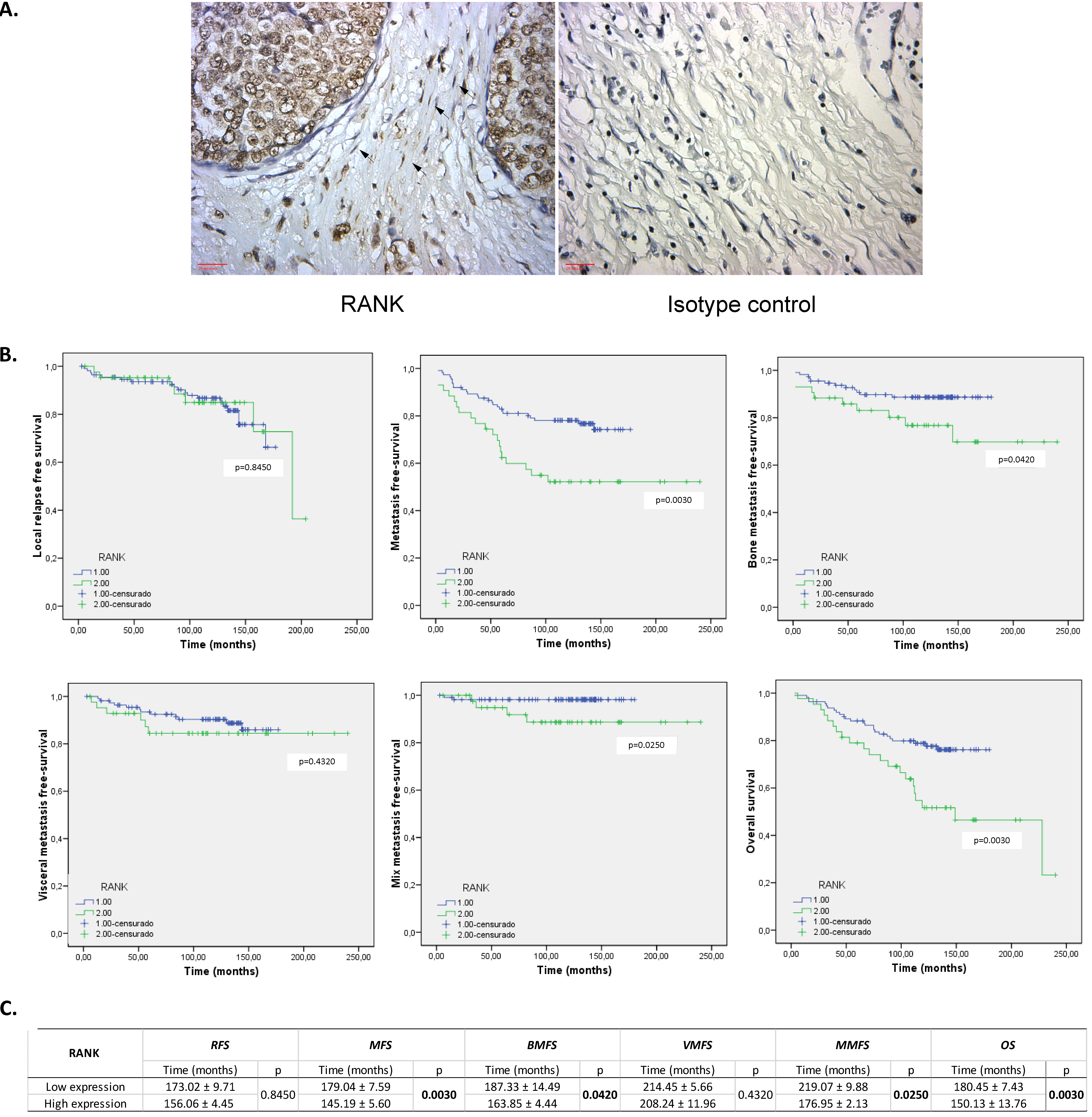 Expression of RANK in CAFs from the primary tumor of BCPs. Left panel: representative example of RANK immunostaining (brown chromogen) in stromal cells assessed in the primary tumor tissue of a BCP. Right panel: isotype control. Nuclei were stained with hematoxylin (purple color). Original magnification: × 400. Scale bars represent 25 μm. B. Association of RANK expression with local relapse-free survival (RFS), metastasis-free survival (MFS), bone metastasis-free survival (BMFS), visceral metastasis-free survival (VMFS), mix metastasis-free survival (MMFS), and overall survival (OS) in early invasive ductal BCPs. Kaplan-Meier curves (univariate analysis) marked in green represent data from samples with high RANK expression, while blue curves represent samples with negative/low RANK expression. The Log Rank (Mantel-Cox) test was used to assess the Kaplan-Meier curves. *p-value < 0.050. C. Details of RFS, MFS, BMFS, VMFS, MMFS and OS for the negative/low and high RANK expression groups.