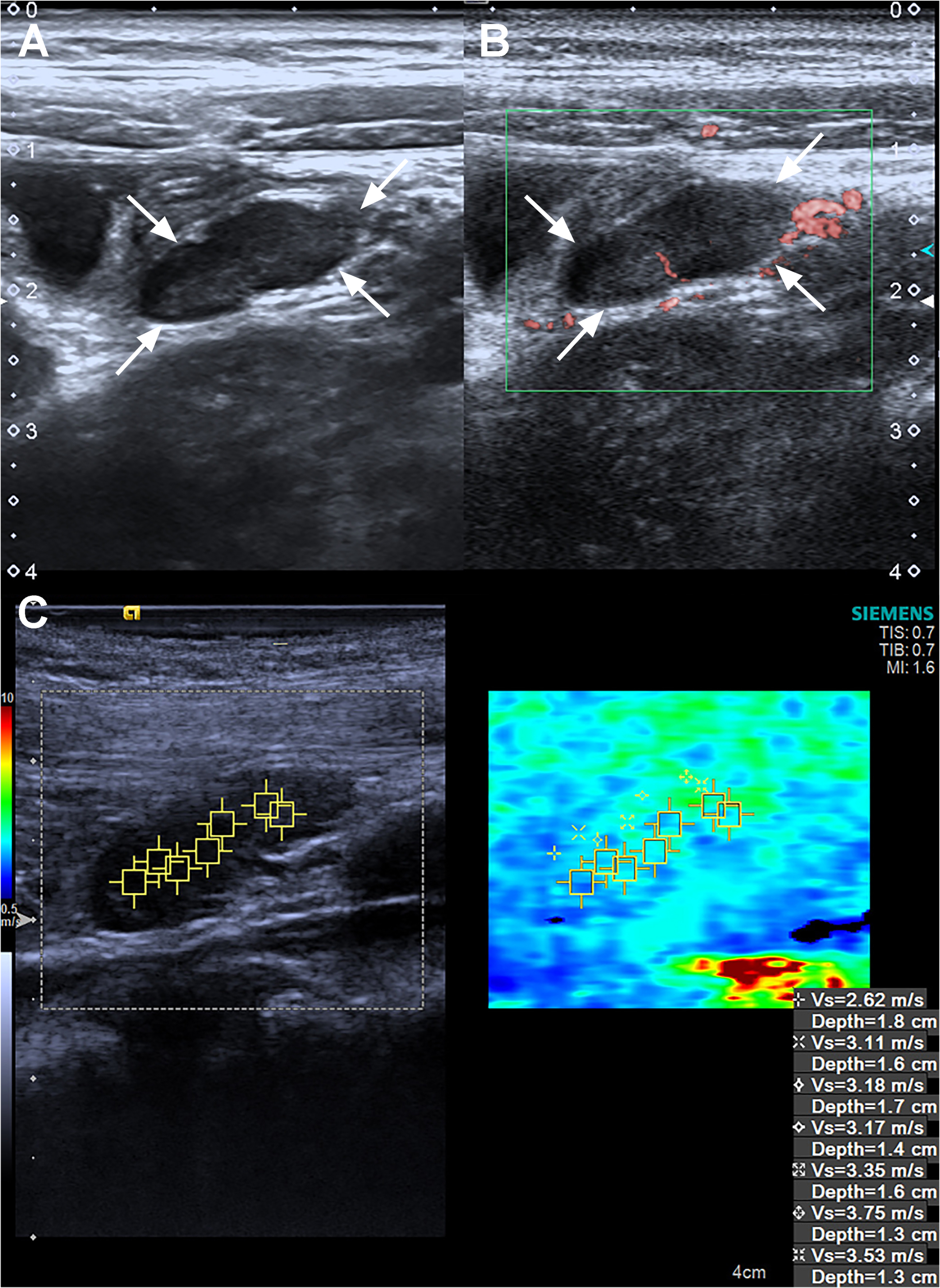 Ultrasound, superb microvascular imaging and Virtual Touch imaging and quantification of a 5 years old pediatric female patient in the control group. (A) B-Mode ultrasound reveals it is a L/S <1 lymph node. (B) Superb microvascular imaging reveals it is an Adler G1 node. (C) Virtual Touch imaging quantification reveals the SWVMax, SWVMin, and SWVMean of the node is 3.75 m/s, 2.62 m/s, and 3.24 m/s. SWVMax = maximum shear-wave velocity, SWVMin = minimum shear-wave velocity, and SWVMean = average shear-wave velocity.