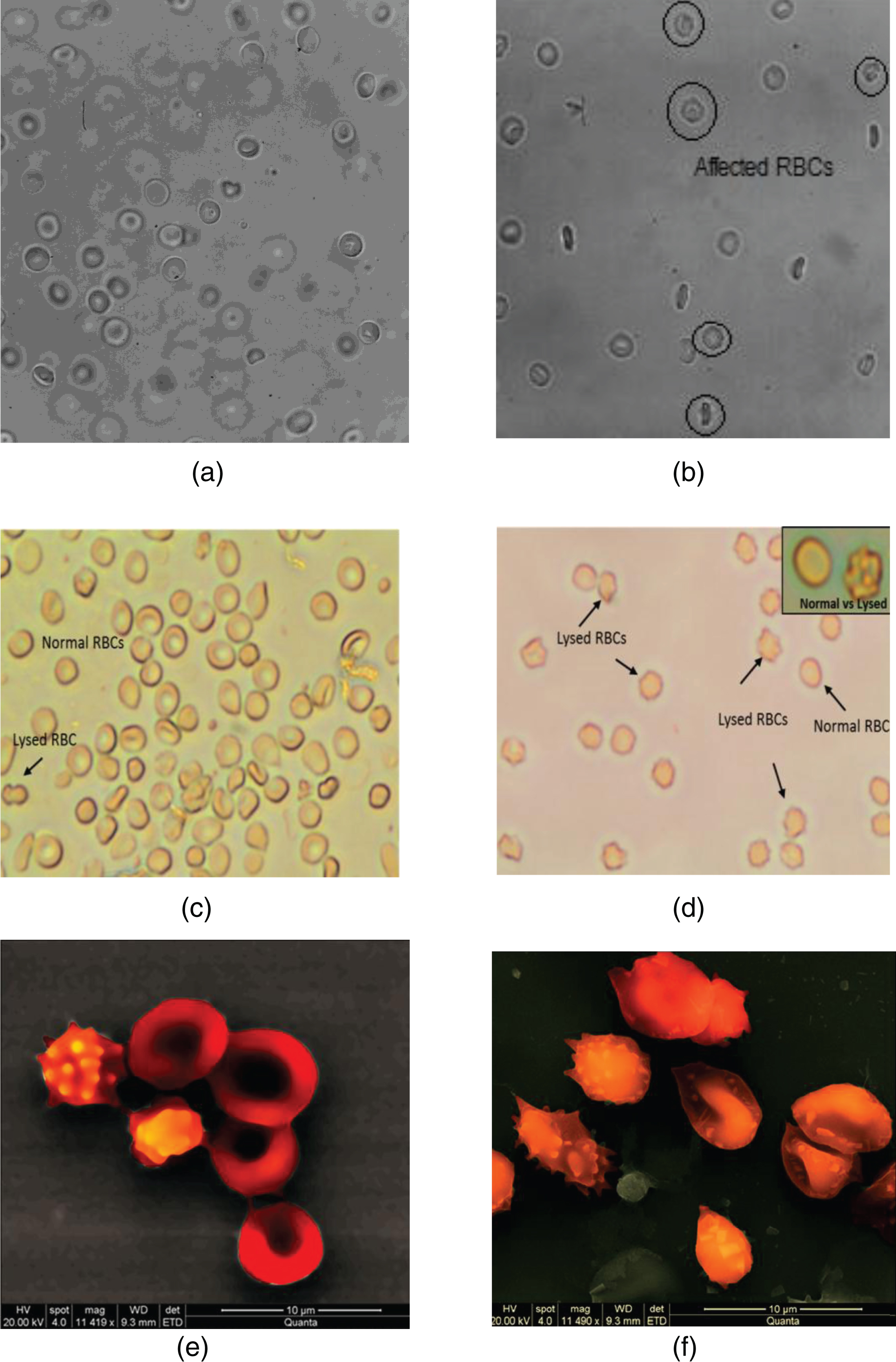 Representative images of RBCs captured by conventional microscopy (Panels (a), (b), (c) and (d)) and SEM (panels (e) and (f)). The images in Panels (a) and (b) have been captured from samples infused in the stented configuration, for the BL and the Q70 conditions respectively. The images in Panels (c) and (d) illustrate the appearance of a population of affected RBCs for the Q35 condition. Panels (e) and (f) show details of affected RBCs.
