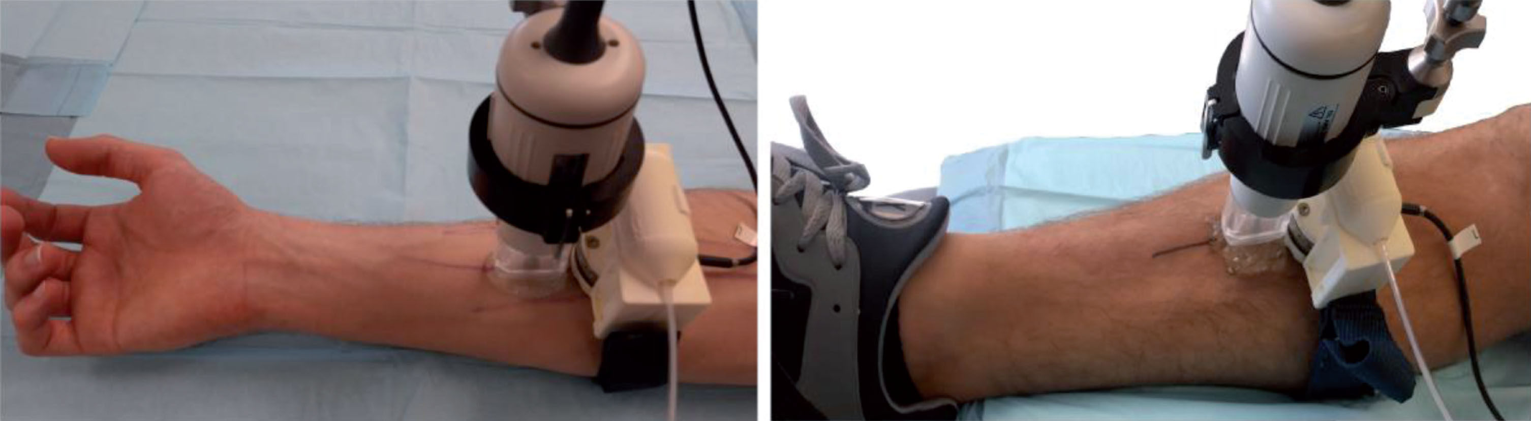 Picture showing the load cell mounted on the pneumatic bracelet device, the venous architecture of the forearm and leg marked with ink, and the Visualsonics ultrasound probe RMV-703 positioned over the region of the measure.