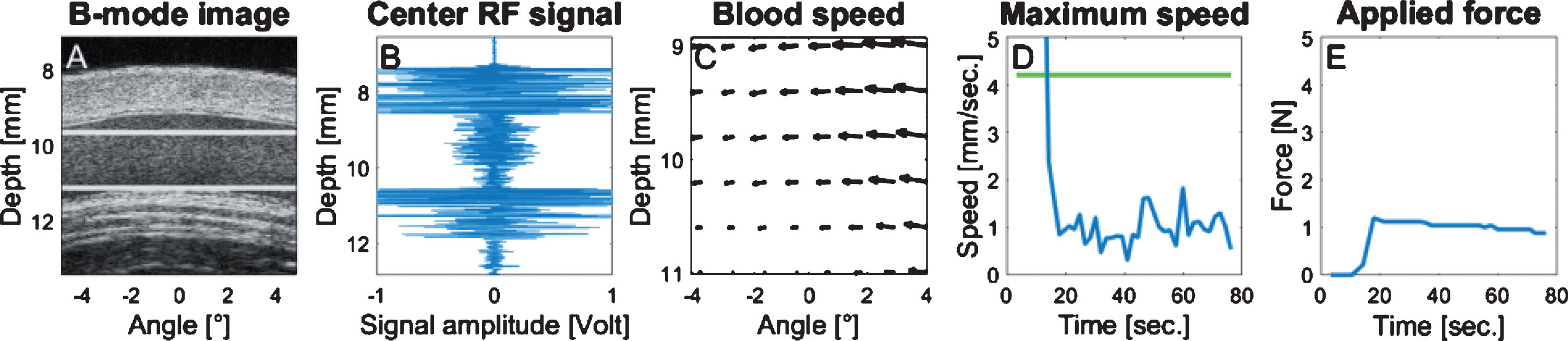 Illustration of the control panel used during data acquisition. Each panel was automatically refreshed over time. (A) Longitudinal B-mode image of the vein; (B) acquired radiofrequency ultrasound data (depth versus normalized amplitude); (C) displacement map of the blood flow, the length of each vector corresponds to the instant displacement. The blood speed map region corresponds to the region delimited by the 2 white horizontal lines within the flow stream of panel A. (D) Maximum flow velocity within the blood speed map over time (in mm/s versus s), the green line corresponds to the threshold limit according to the vein diameter; (E) force applied by the bracelet and monitored by the force sensor over time (in Newton versus s).
