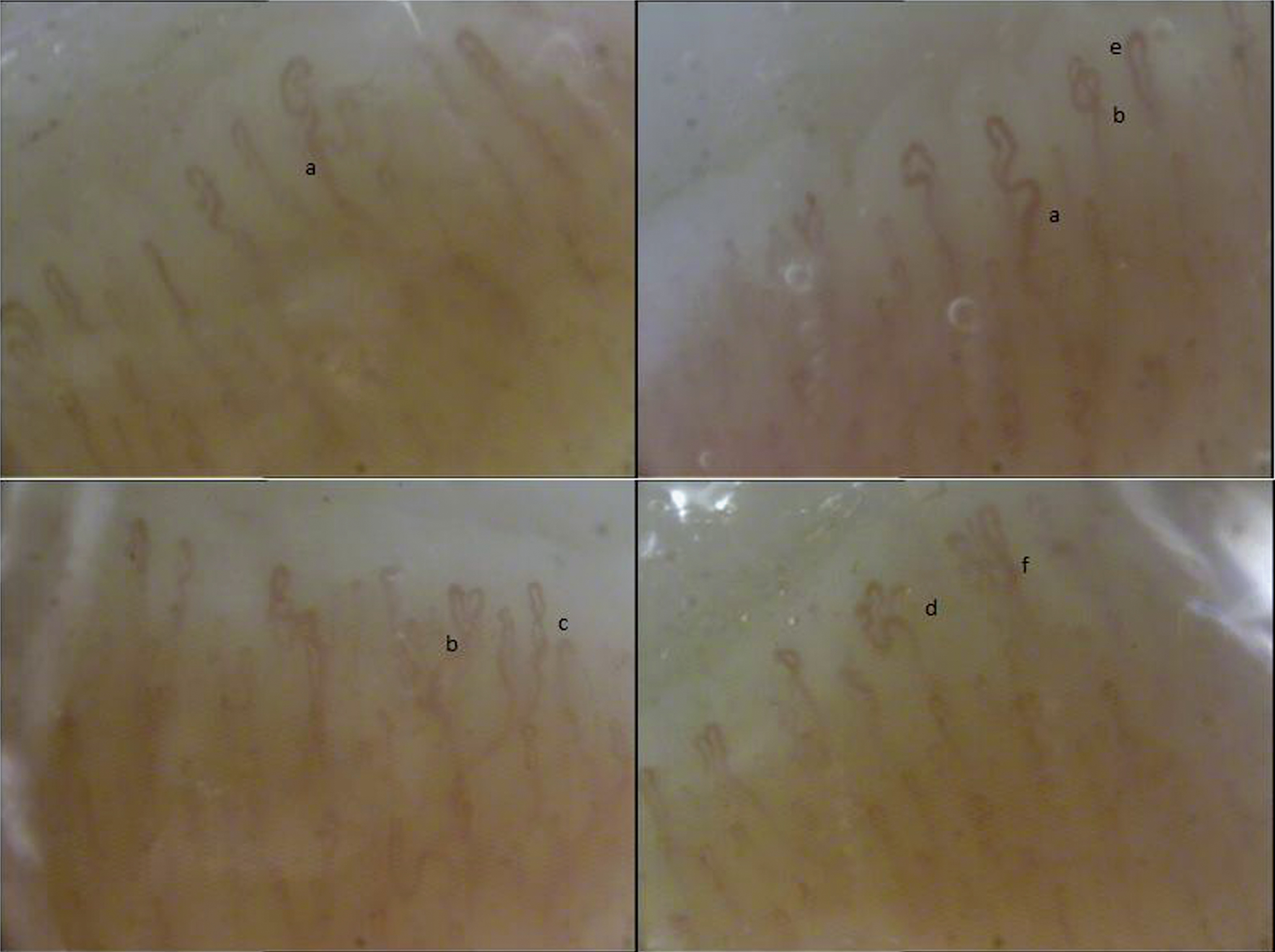 Nailfold videocapillaroscopy images in a case of volleyball player showing a “non-specific pattern”: a) ectasia of the efferent tract of the loops, b) apical ecatsia, c) tortuosity and newly formed capillaries with d1) bushy, d2) branching, d3) “candelabrum” appearance.