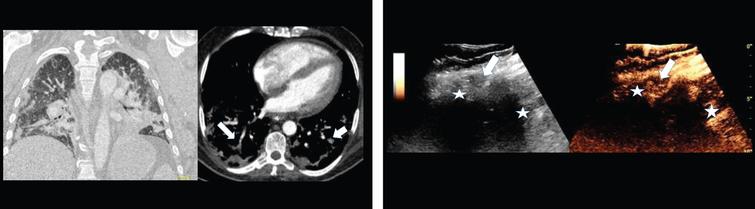 1A: Contrast enhanced computed tomography (CT) of a 48 years old male COVID-19 patient with pulmonary arterial embolism of the right lung (arrow) and consolidation on both sides. Documentation with two different windows for vascular structures and lung parenchymal changes.