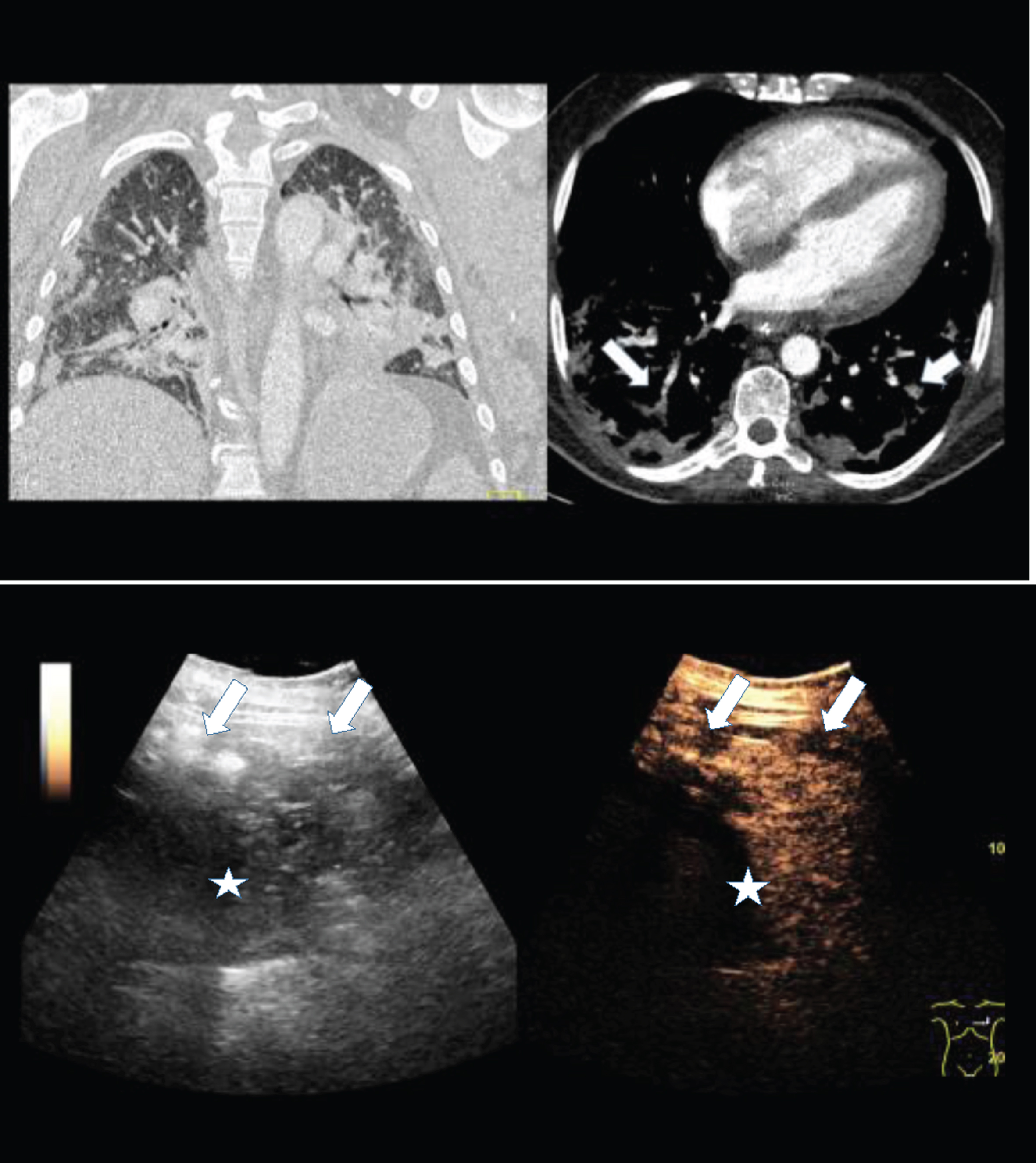 2A: Contrast enhanced computed tomography (CT) of a 56 years old female COVID-19 patient with pulmonary arterial embolism of the right lung (arrow) and consolidation on both sides. Documentation with two different windows for vascular structures and lung parenchymal changes.