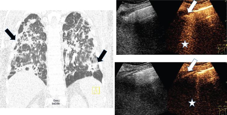 Computed tomography (CT), B-mode and contrast enhanced ultrasound (CEUS) of a 68 old female COVID-19 patient with pulmonary infection (arrow) and pleural effusion. Irregular pleural enhancement, irregular parenchymal enhancement and B-lines of inflammatory consolidation (asterisk).
