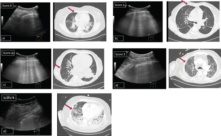 Grading system of lung opacities used for the lung aeration score in patients with ARDS and COVID-19 pneumonia. Shows findings of LUS in patients with COVID-19 pneumonia and corresponding HRCT scans. 5 levels of typical opacities of the lung could be observed and were graded in a scoring system from minimum 0 points to maximum 4 points. a) Score 0: A-lines detected by ultrasound B-mode using a 1–5 MHz convex probe and corresponding HRCT scan (CT was done 3 days before LUS). b) Score 1: More than 2 (≥3) single B-lines detected by ultrasound B-mode using a 1–5 MHz convex probe and corresponding HRCT scan (CT was done 3 days before LUS). c) Score 2: Multiple, coalescent B-lines detected by ultrasound B-mode using a 1–5 MHz convex probe and corresponding HRCT scan (CT was done 4 days before LUS). d) Score 3: Marked pleural disruptions detected by ultrasound B-mode using a 1–5 MHz convex probe and corresponding HRCT scan (CT was done at the same day as LUS). e) Score 4: Severe consolidations with air bronchogram sign detected by ultrasound B-mode using a 1–5 MHz convex probe and corresponding HRCT scan (CT was done at the same day as LUS).
