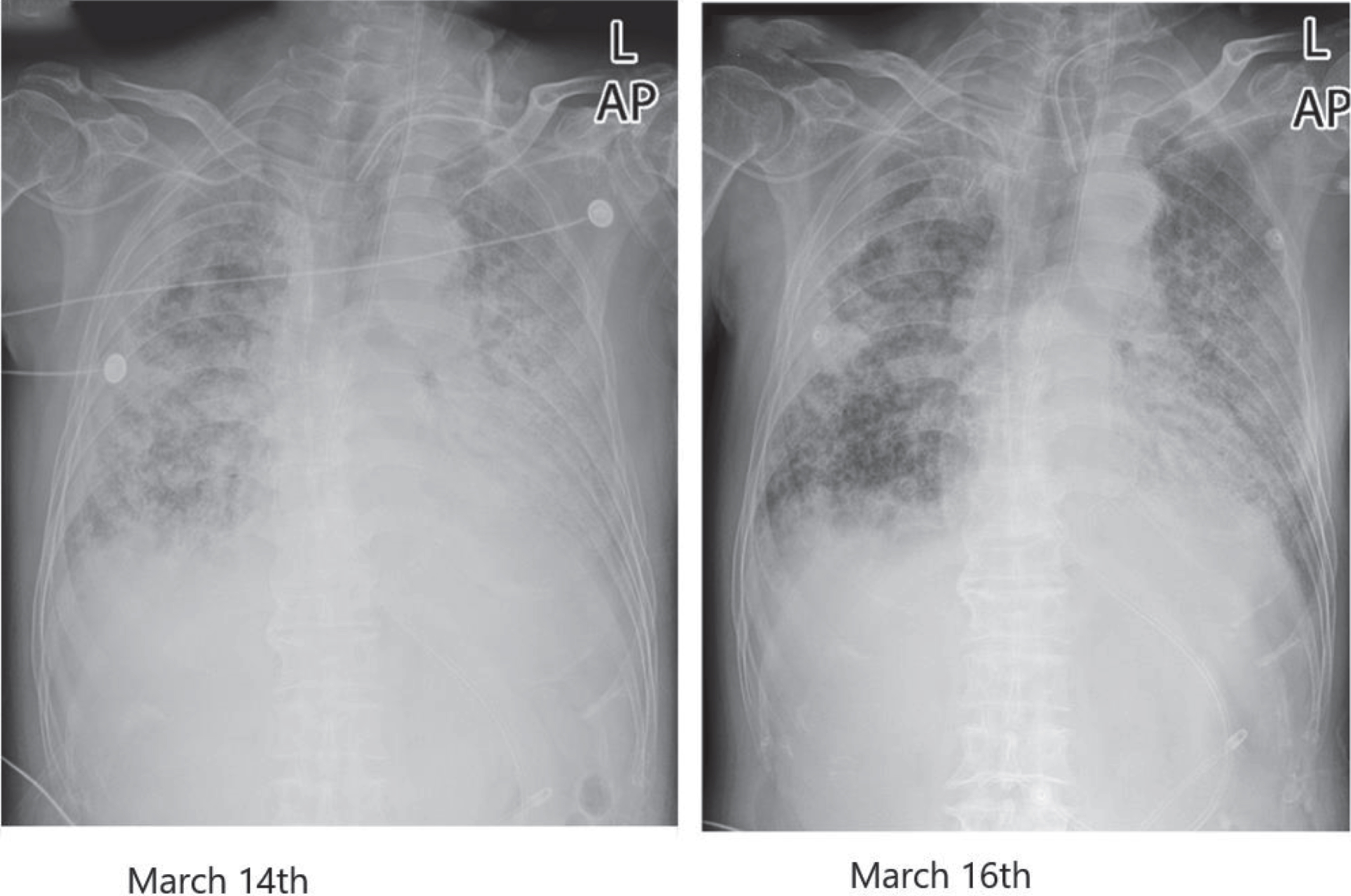 Chest radiograph comparison before and after treatment in case 2.