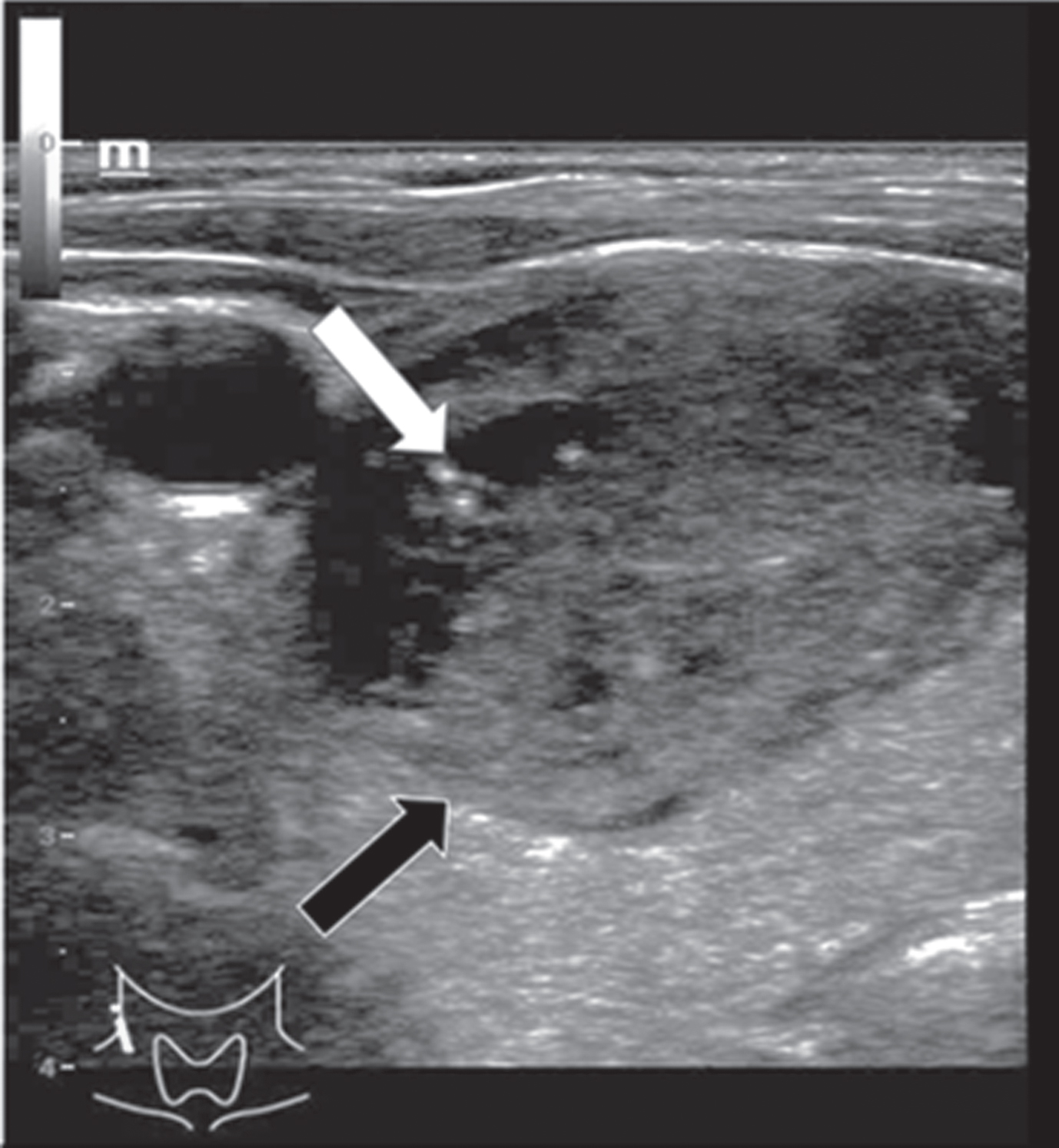 B-mode examination of a right thyroid lobe in cross section of a 61-year-old patient with histo-pathologically proven thyroid adenoma. Micro-calcifications (white arrow) as well as a rather incomplete margin (black arrow) can be spotted in this image. There are strong differences between the echogenicity of the adenoma, in particular its margins, and the surrounding thyroid tissue.