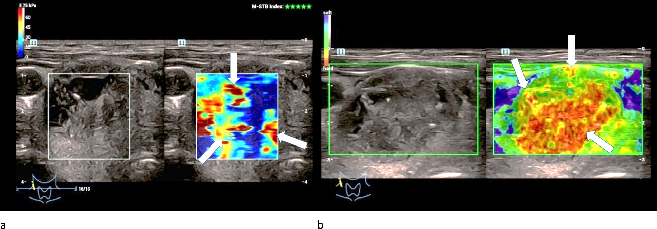 Strain- (left/a) and shear-wave elastography (right/b) on a right thyroid lobe from a 61-year-old patient with histo-pathologically proven thyroid adenoma. Irregular hard areas (white arrows) can be found in both modi. In strain the hardenings are predominently located along the right margin of the lesion whereas in shear-wave the whole lesion seems to be hardened.