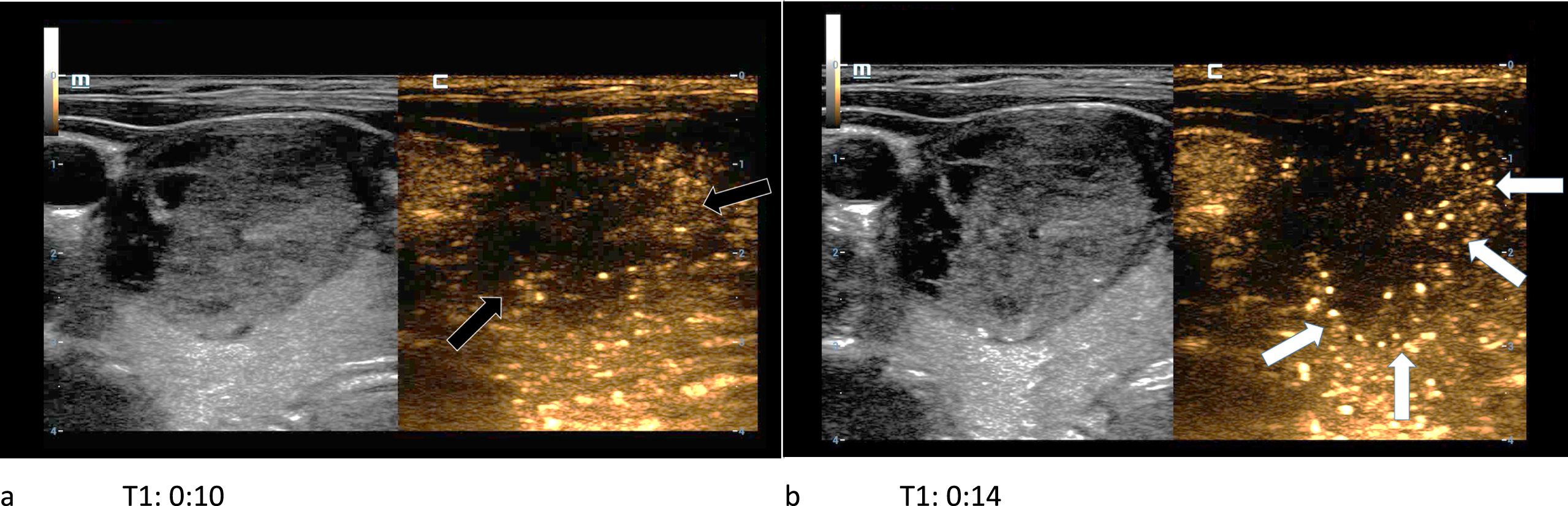 61-year-old patient with histopathologically proven thyroid adenoma. In the first picture (left/a) the CEUS kinetics of the lesion are depicted only seconds after the bolus injection of 1.5 ml SonoVue®. The margins of the lesion did not absorb a lot of microbubbles (black arrows). In the subsequent picture (right/b) a contrast enhancement of the lesions’ margins called wash-in (white arrows) occurs. A wash-out phenomenon did not take place.