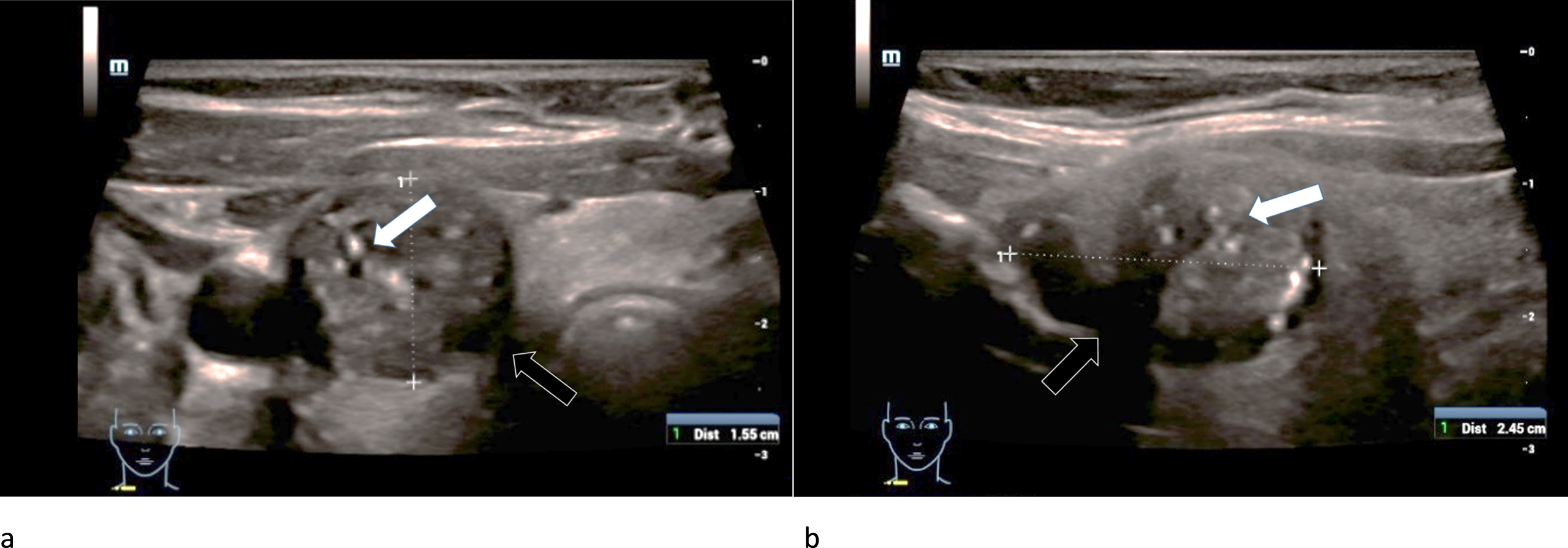 B-mode examination of a right thyroid lobe in cross section (left/a) and longitudinal view (right/b) of a 69-year-old patient with histo-pathologically proven papillary thyroid cancer. Micro-calcifications (white arrows), a diffuse, incomplete margin (black arrows) and a marginal notably reduced echogenicity compared to the surrounding thyroid tissue can be found. These are B-mode signs for malignancy.