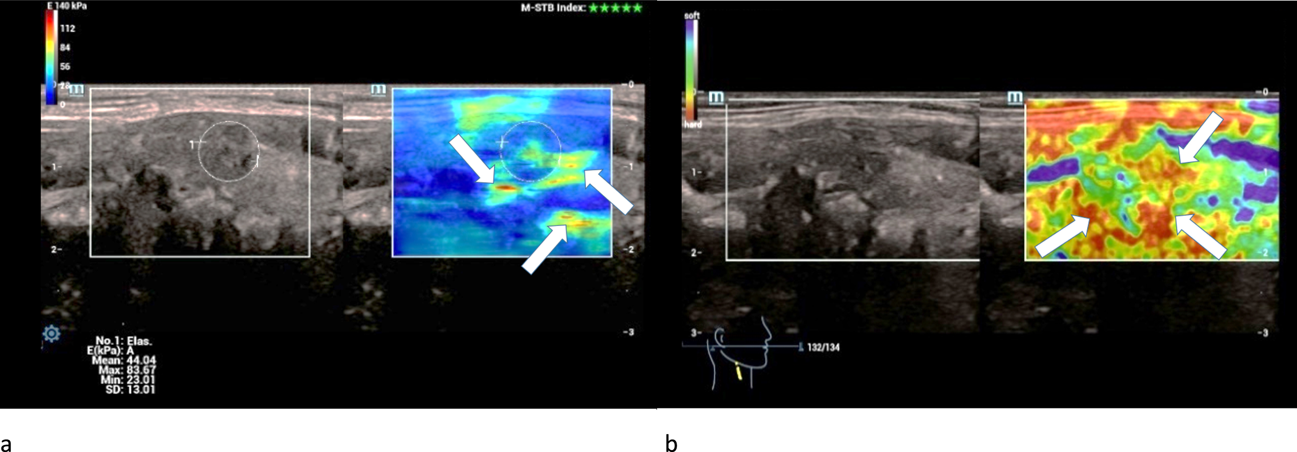 36-year-old patient with histo-pathologically proven papillary thyroid cancer. Strain- (left/a) and shear-wave elastography (right/b) of a right thyroid lobe showed irregular hard areas (white arrows) in both modi. They are predominently located at the margins.