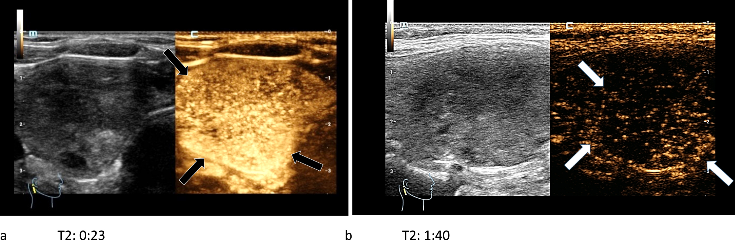 44-year-old patient with histo-pathologically proven papillary thyroid cancer. After the bolus injection of 1.5 ml SonoVue® the CEUS-kinetics of the lesion were documented: an early irregular marginal and central enhancement phenomenon (black arrows) called wash-in (left/a) took place. An early wash-out (white arrows) during the late arterial phase (right/b) was visible.