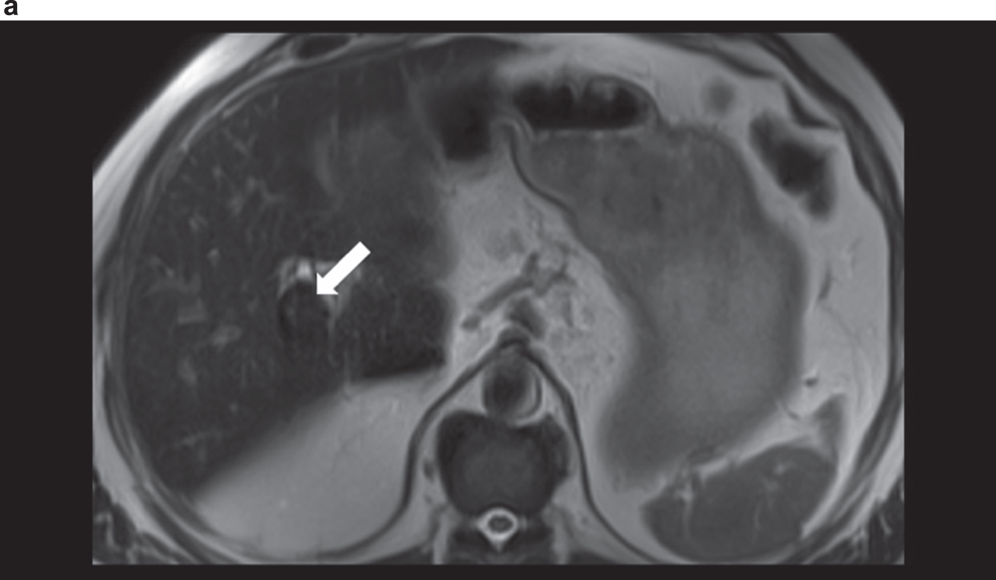 MRI in T2 weighted sequence with unclear vascularised structure (arrow) at the hepatic hilus with signal change.