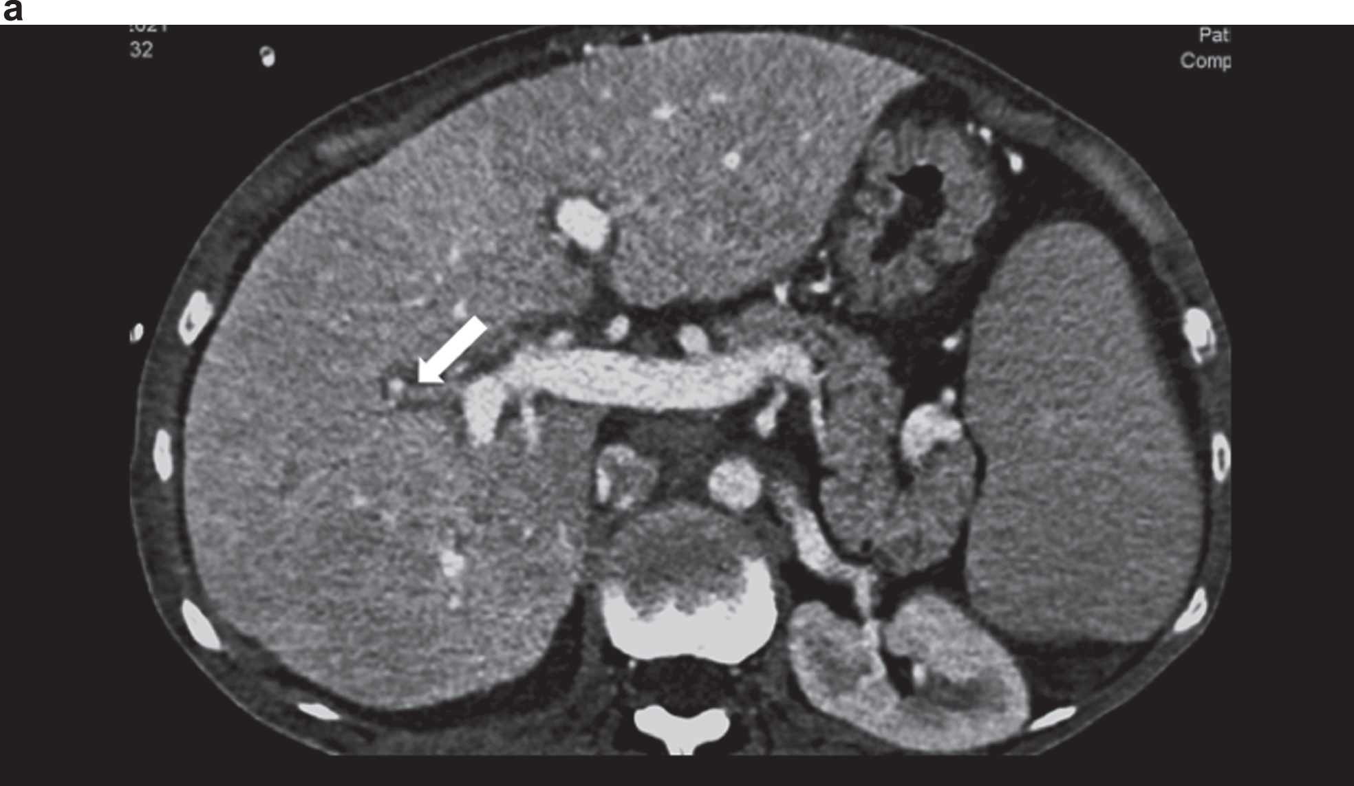Contrast-enhanced CT showing an irregular hepatic artery (arrow), inhomogeneous contrast of the liver in cirrhosis and changes in angiosarcoma in the right lobe of the liver.