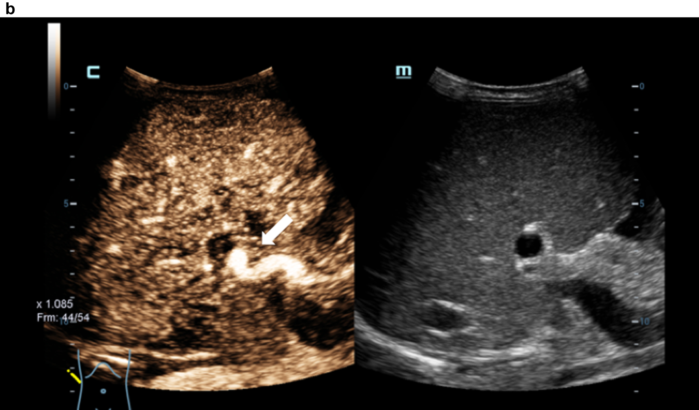 Contrast medium sonography (CEUS) with detection of the irregular early liver contrast and the elongated hepatic artery (arrow). Inhomogeneous liver in the grey image.