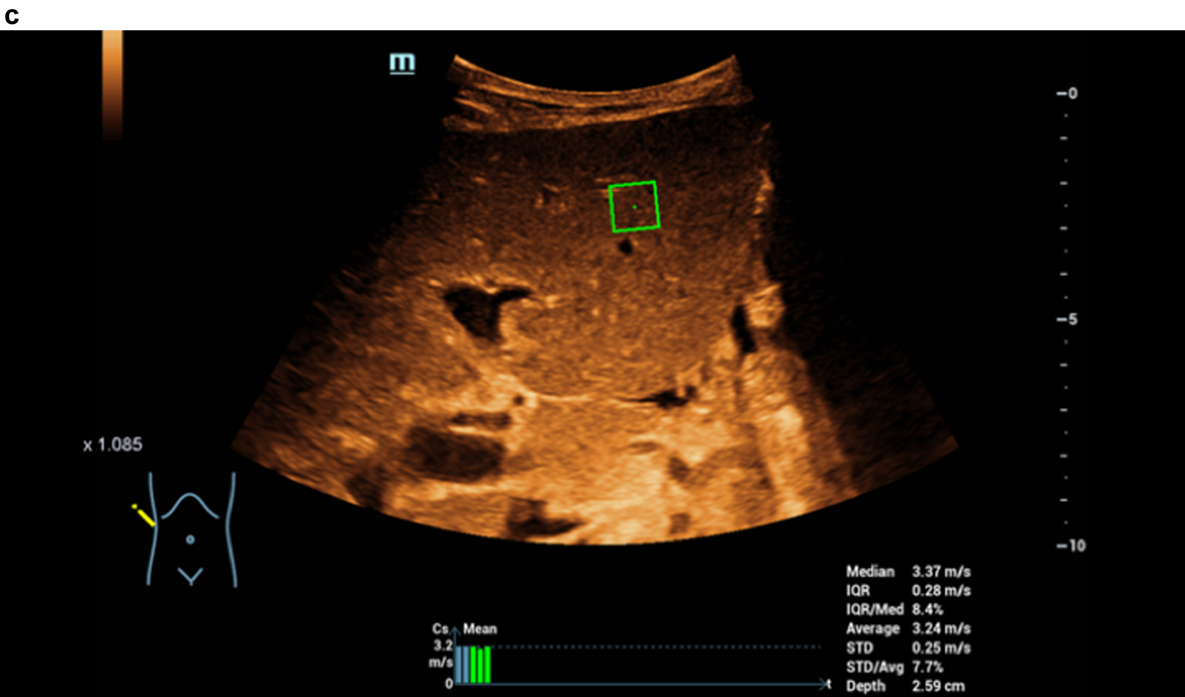 STQ shear wave elastography and readings up to 3.37 m/s as clear densification of the liver in cirrhosis.