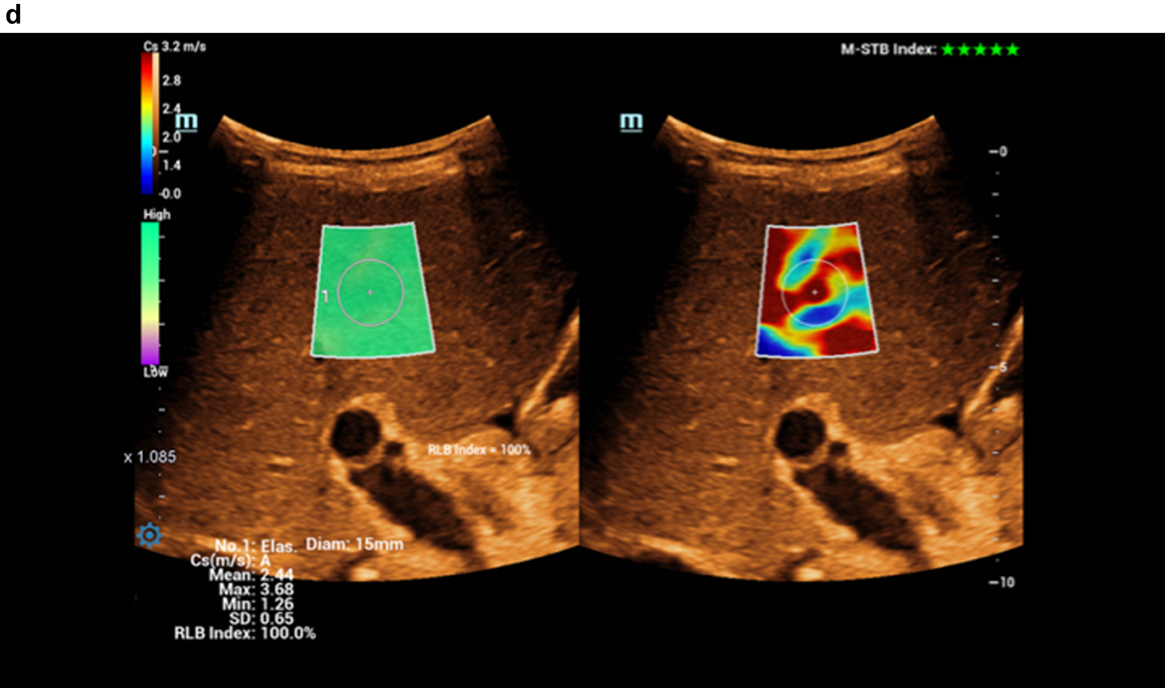 Color-coded evaluation of fatty liver with shear wave elastography showing signs of cirrhosis. Highest quality indicator (5 green marks).