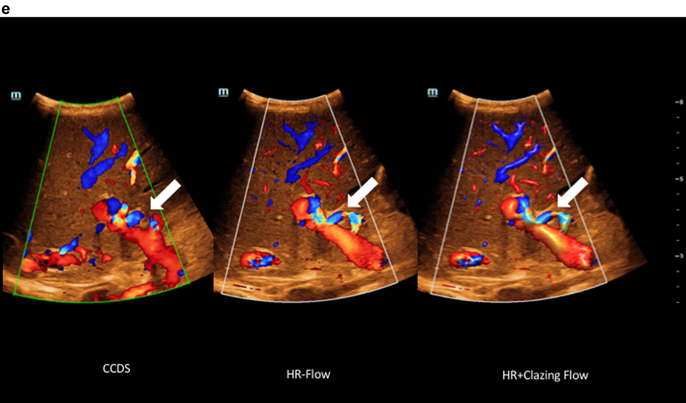Comparison of flow imaging with CCDS and HR and Glazing Flow with significantly lower artefacts and higher image quality for the detection of the elongated arteria hepatica (arrow), the vena portae and the hepatic veins with HR and Glazing Flow.