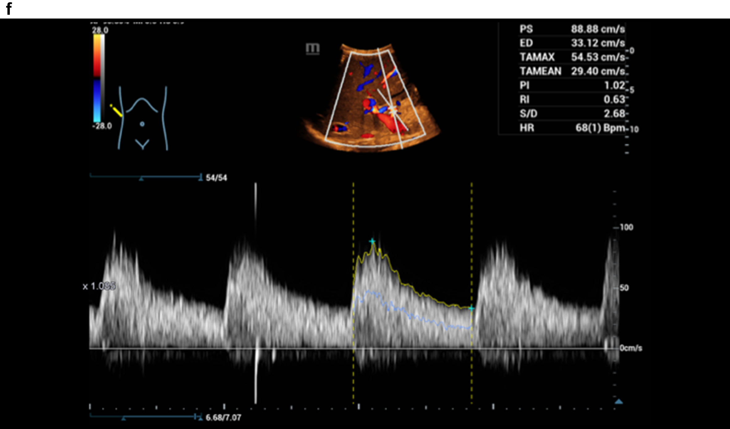 Haemodynamic assessment of the hepatic artery with CCDS, HR and Glazing Flow.