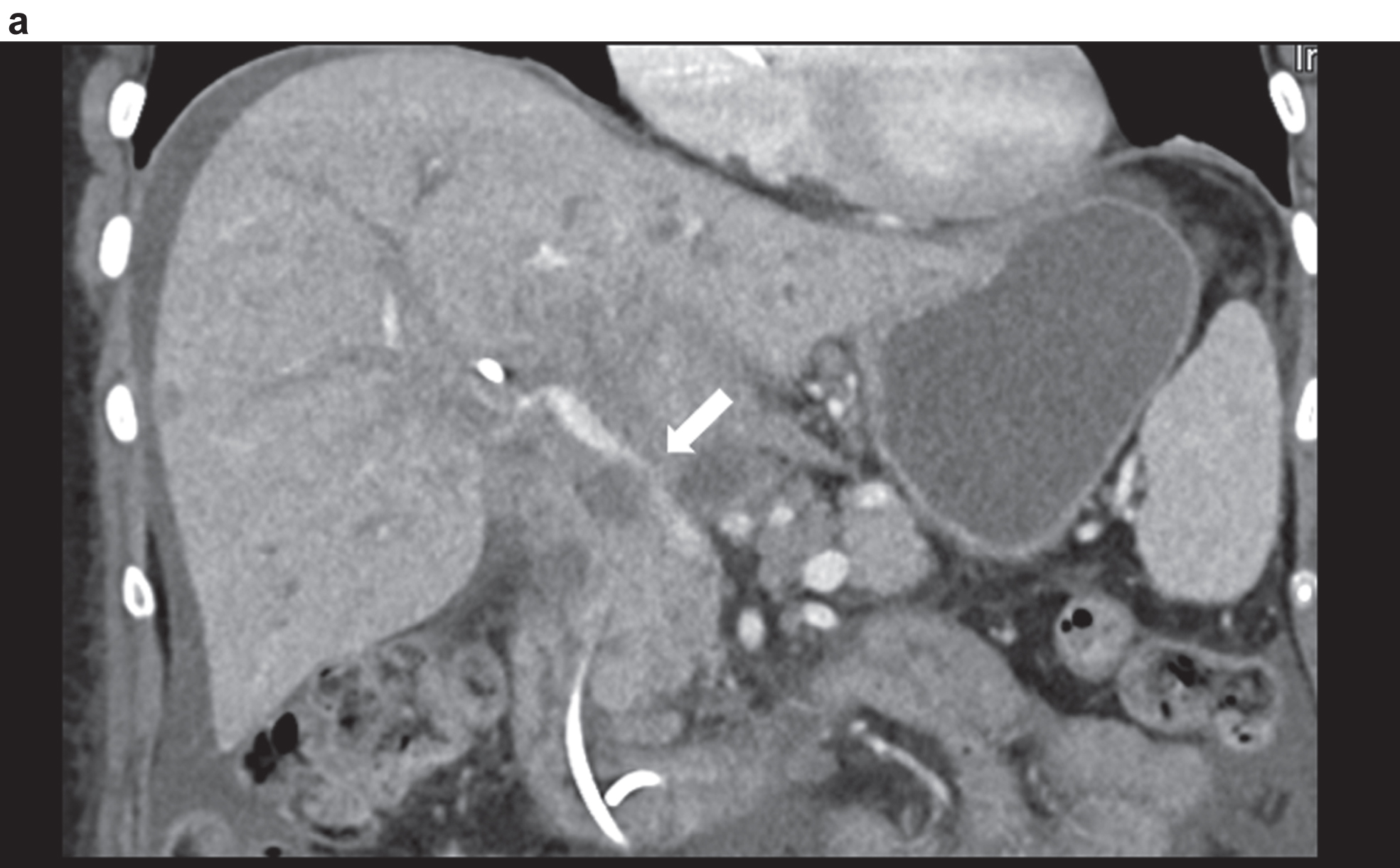 Highest degree of lumen reduction of the portal vein, confluens and superior mesenteric vein (VMS) due to space occupation at the mesenteric root, at the hepatic hilus and intrahepatic in contrast-enhanced CT. Vascular narrowing of the port vein (arrow).