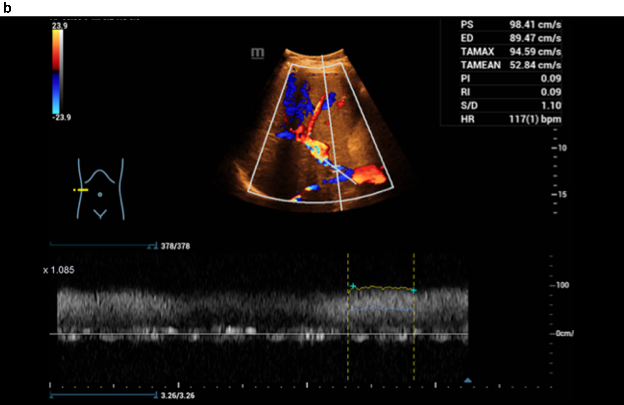 Flow assessment with CCDS, the constriction at the port vein with flow artefacts in color and in Doppler spectrum, alaising, blooming and proportionally also with vibrations.