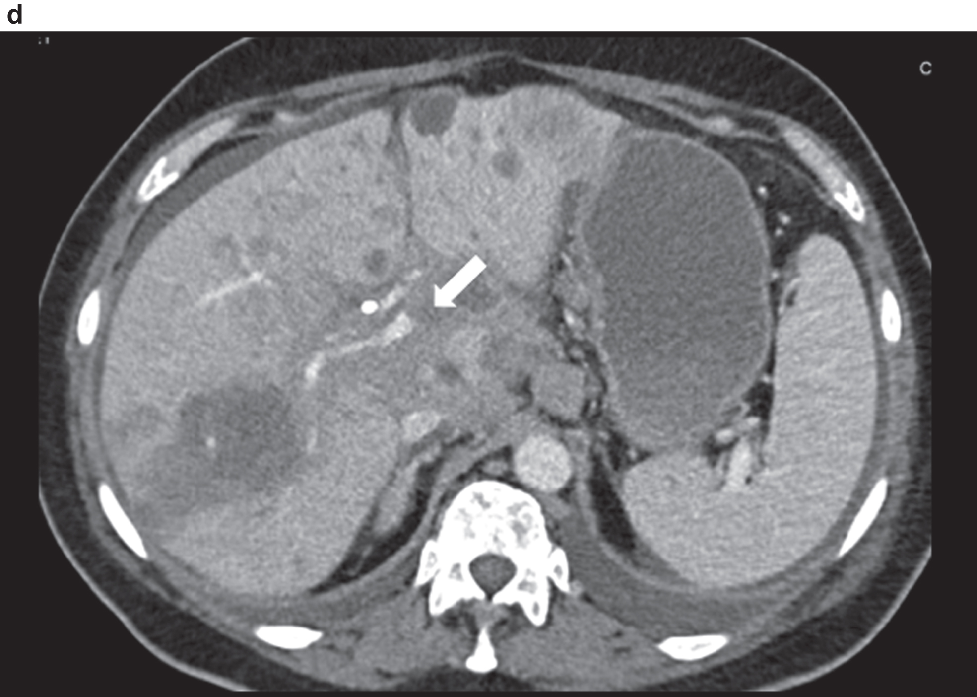 CT image of the pronounced constriction of the portal vein and VMS in the region of the hepatic hilus and the mesenteric root.