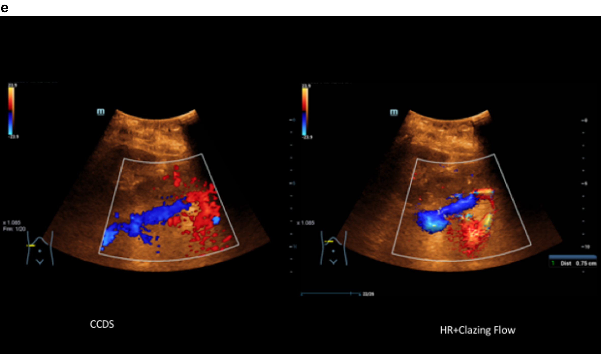 Comparison of CCDS and HR and Glazing Flow with lower flow artefacts by using HR and Glazing Flow in the pronounced venous constriction of the confluence, VMS and portal vein.
