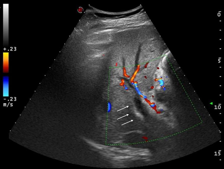 Abdominal ultrasound showing portal vein thrombosis.
