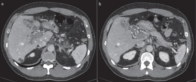 Contrast enhanced computed tomography showing portal vein thrombosis (a) and collateral vessels (b).
