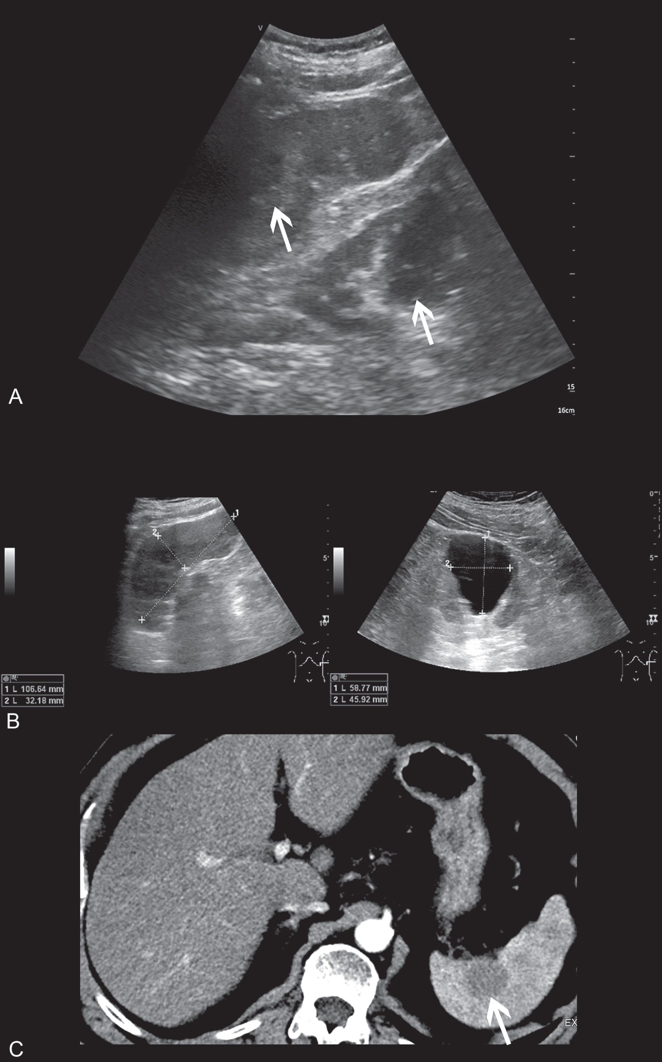72 year old patient, diagnosed with T4 tonsillar carcinoma, who underwent CT for evaluation of metastatic lesions. A: Vscan image of the upper abdomen showed hypoechogenic splenic and renal lesions, marked with arrow. Image quality was rated as 2 due to blurring and low resolution. B: High-end ultrasound image confirmed the hypoechogenic renal and splenic lesions. Images are displayed with a much better resolution and quality (rated as 3). C: Corresponding CT scan of the upper abdomen that showed multiple obscure splenic hypodensities with diminished contrast enhancement. Pathologies are marked with an arrow.