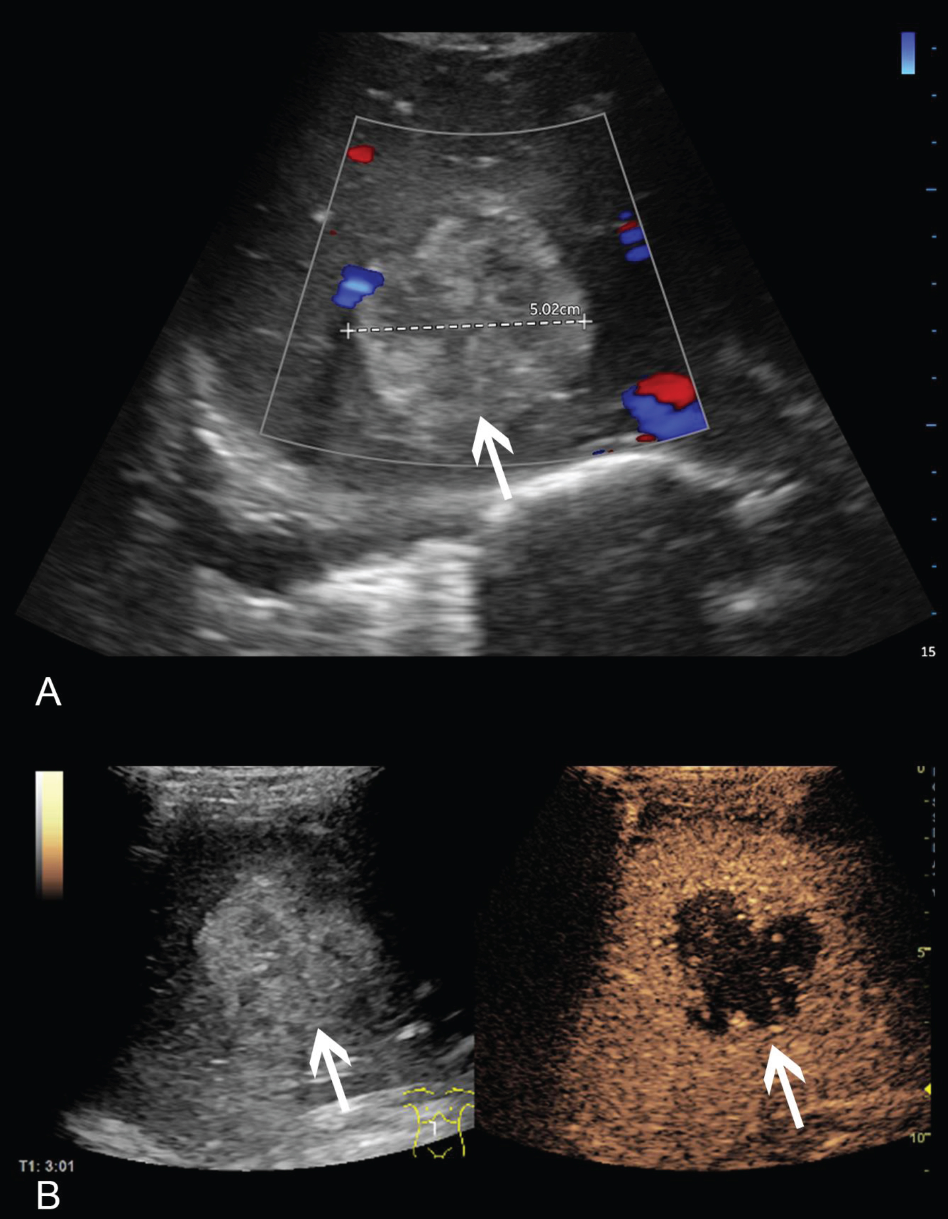 69 year old patient with newly diagnosed retroauricular malignant melanoma. A: Vscan ultrasound showed a 5 cm hyperechogenic hepatic lesion with no relevant perfusion on CCDS. Image quality was rated as 3 altogether. B: High-resolution ultrasound confirmed this lesion. CEUS revealed a typical nodular centripetal enhancement, consistent with a partially thrombosed hemangioma. Image quality was rated as excellent (4). Pathologies are marked with an arrow.