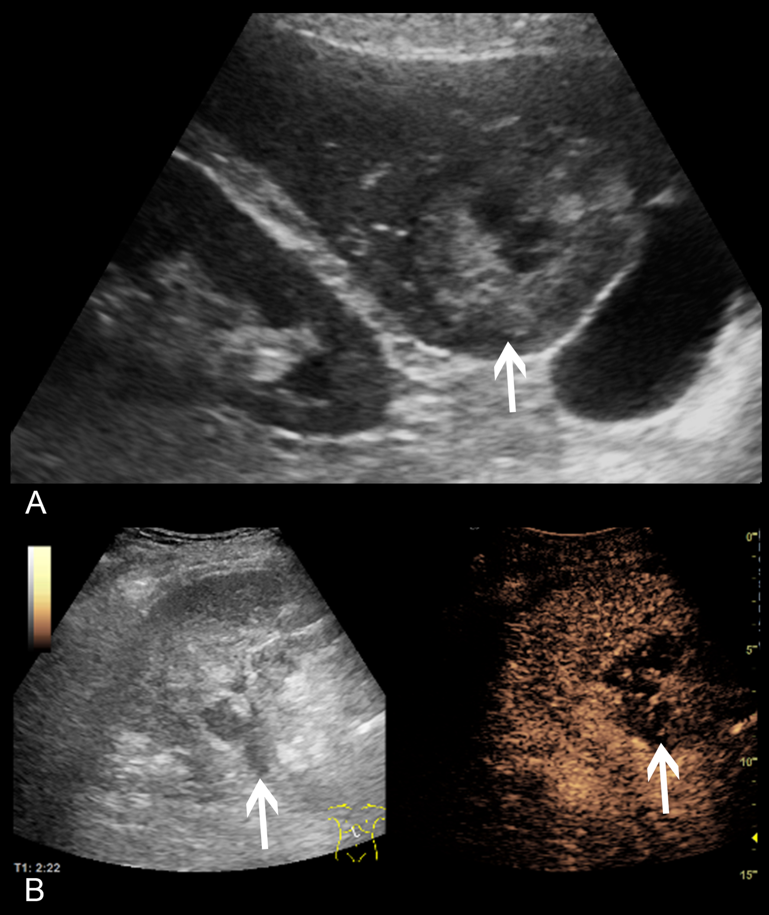 61 year old patient with previous liver transplantation, admitted to our hospital with fever of unknown origin. A: Vscan image showed a large partially hyperechogenic mass with central hypoechogenicity and adjacent free abdominal fluid. Image quality showed only minor diagnostics limitations (3). B: High-end ultrasound with CEUS revealed several hypoechogenic lesions with profound enhancement in between. In correlation with an MRI scan, multiple cholangitic abscesses were confirmed. Image quality was found to be excellent (4). Pathologies are marked with an arrow.