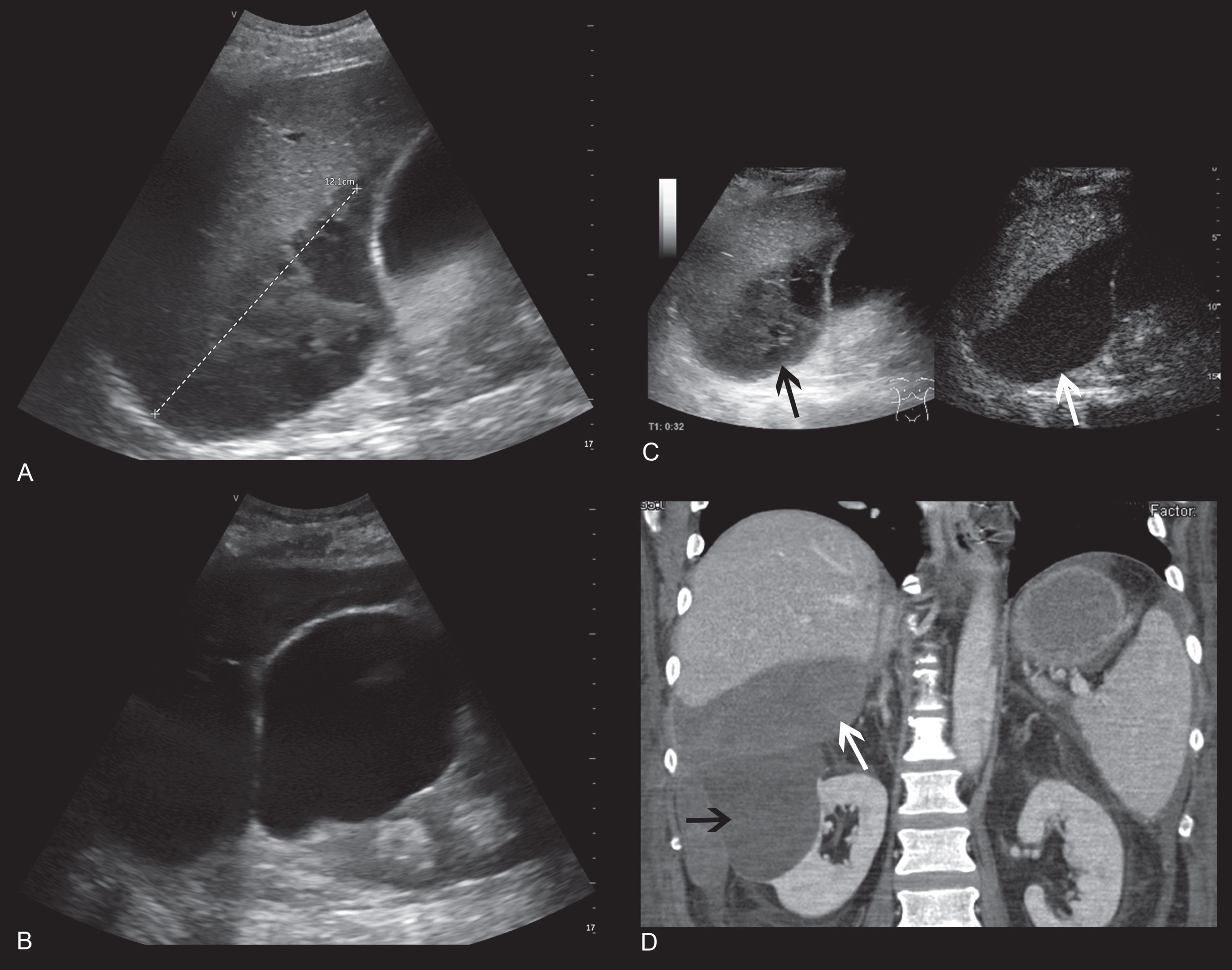 49 year old patient following liver transplantation with acute decrease in hemoglobin. A/B: Vscan images display an extensive subhepatic hematoma and a large renal cyst. Image quality showed only minor diagnostic limitations (3) C: High-end ultrasound image conformed the subhepatic hematoma as well as the adjacent renal cyst, clearly separated. Image quality of the exam was found to be excellent. D: On a ceCT scan for elimination of an acute bleeding, both pathologies were clearly visible. Pathologies are marked with an arrow.