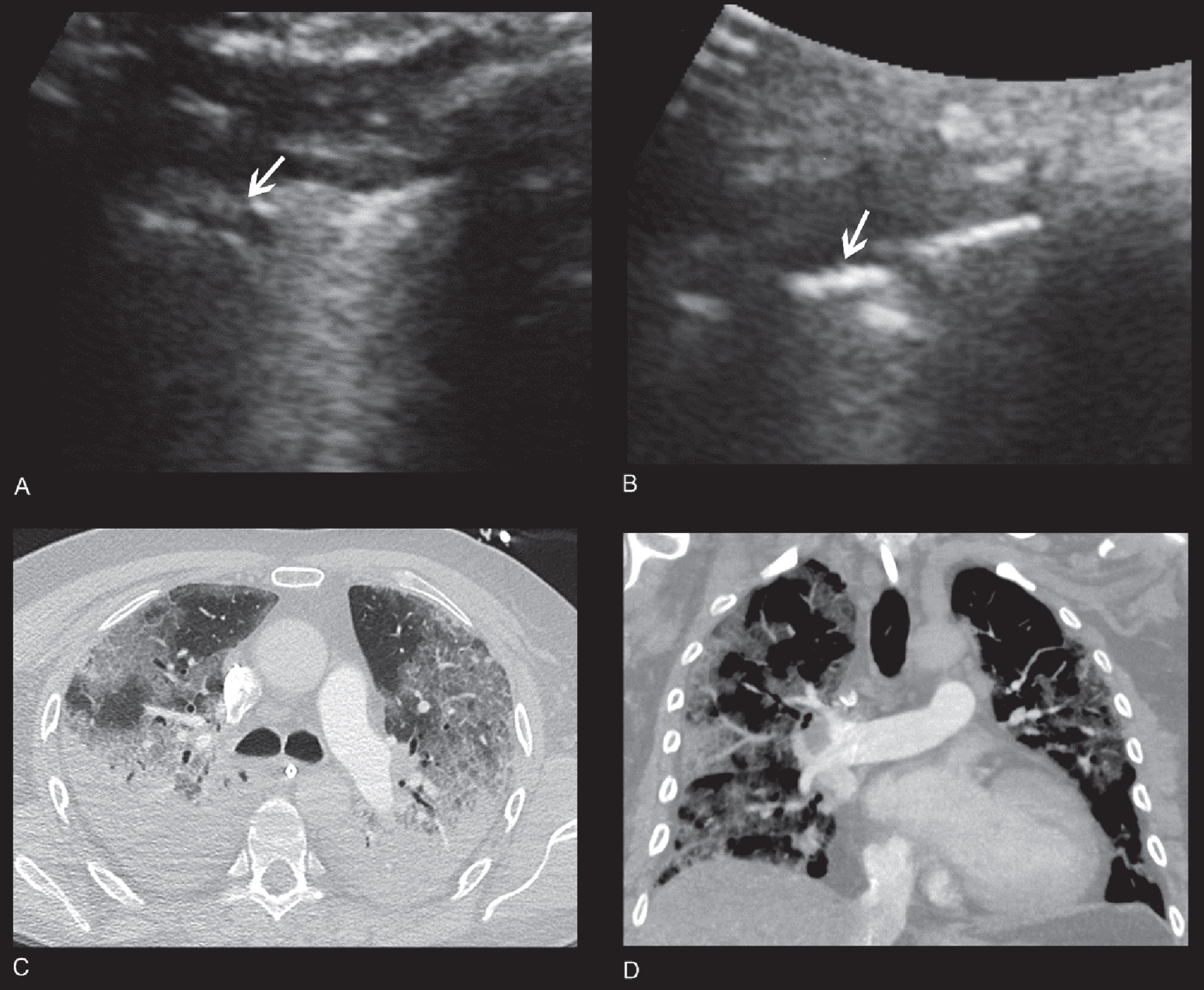 65 year old male patient with severe COVID-19 pneumonia. A/B: Vscan images using a transabdominal probe display consolidations with A- and B-lines. Image quality showed minor diagnostic limitations (2-3). C/D: CT images displaying small bilateral pleural effusions and diffuse, predominantly peripheral ground glass opacities, and peripheral consolidations consistent with COVID-19 pneumonia.