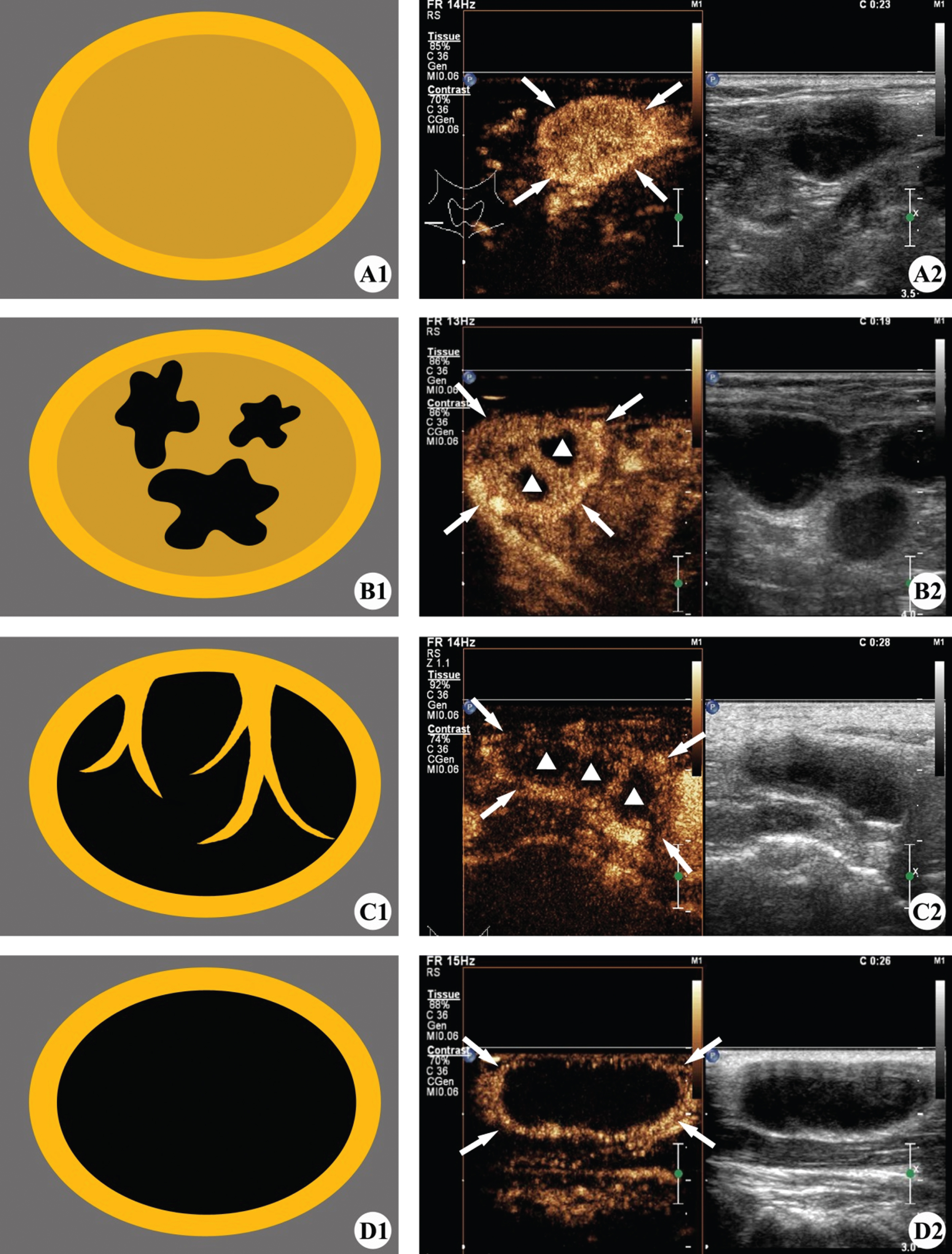 Images present general appearance of CTL for CEUS imaging patterns. (A1, A2) Pattern 1: peripheral rim-like enhancement (⟶) with internal homogeneous enhancement. (B1, B2) Pattern 2: peripheral rim-like enhancement (⟶) and internal heterogeneous enhancement (▵), like “honeycomb”. (C1, C2) Pattern 2: peripheral rim-like enhancement (⟶) and internal heterogeneous enhancement (▵), like “dead wood”. (D1, D2) Pattern 3: peripheral rim-like enhancement (⟶) with non-enhancement inside the lesion.